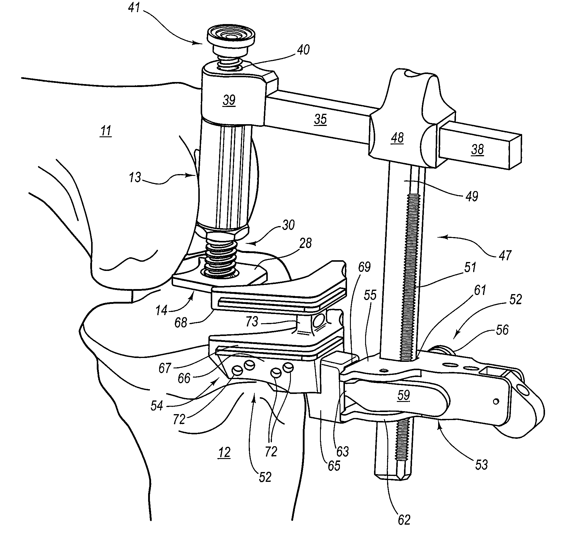 Arthroplasty systems and methods for optimally aligning and tensioning a knee prosthesis