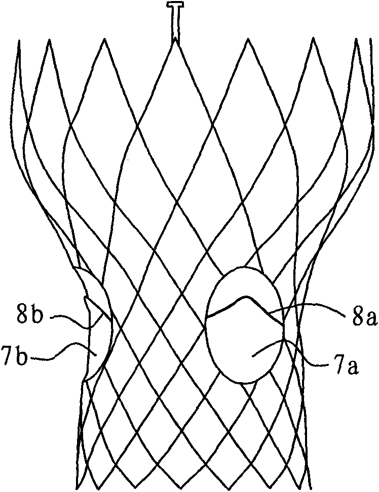 Artificial valve displacement device and stent