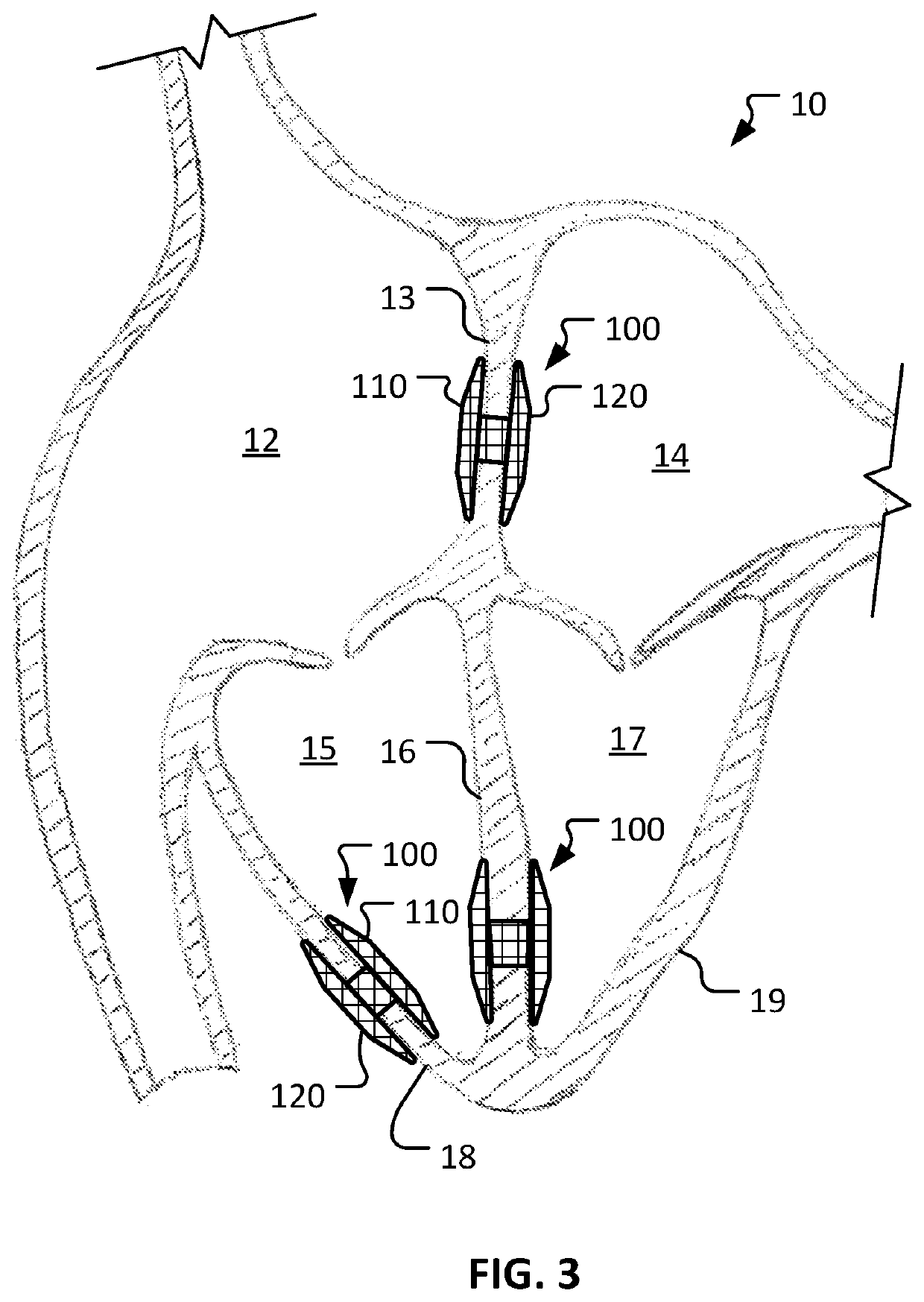 Devices and methods for cardiac pacing and resynchronization