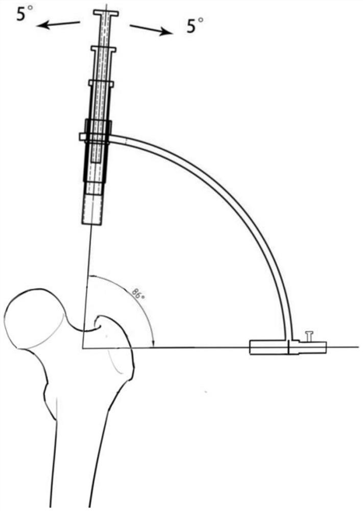 Auxiliary positioning and screw placement device for proximal femoral intramedullary nail