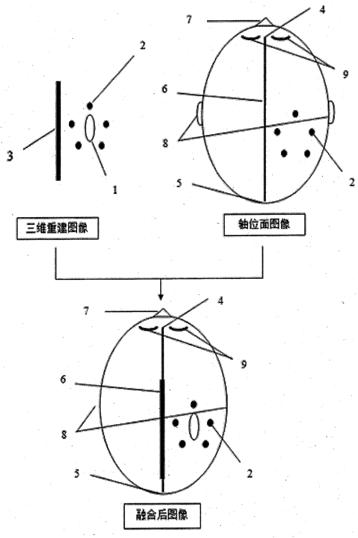 Scalp positioning method for encephalic supratentorial space-occupying lesions