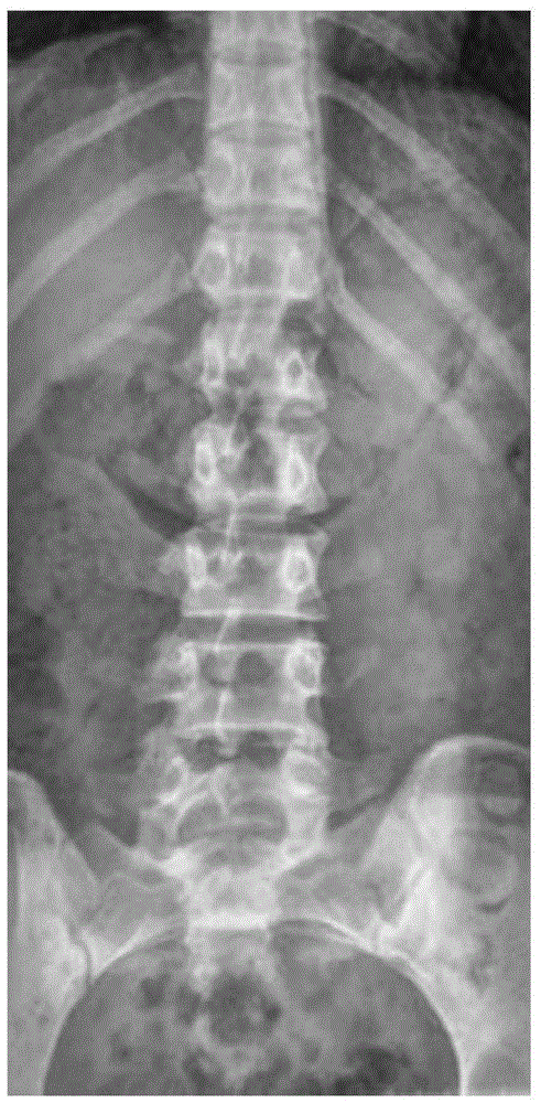 Self-adaptive spinal CT image segmentation method based on particle swarm optimization