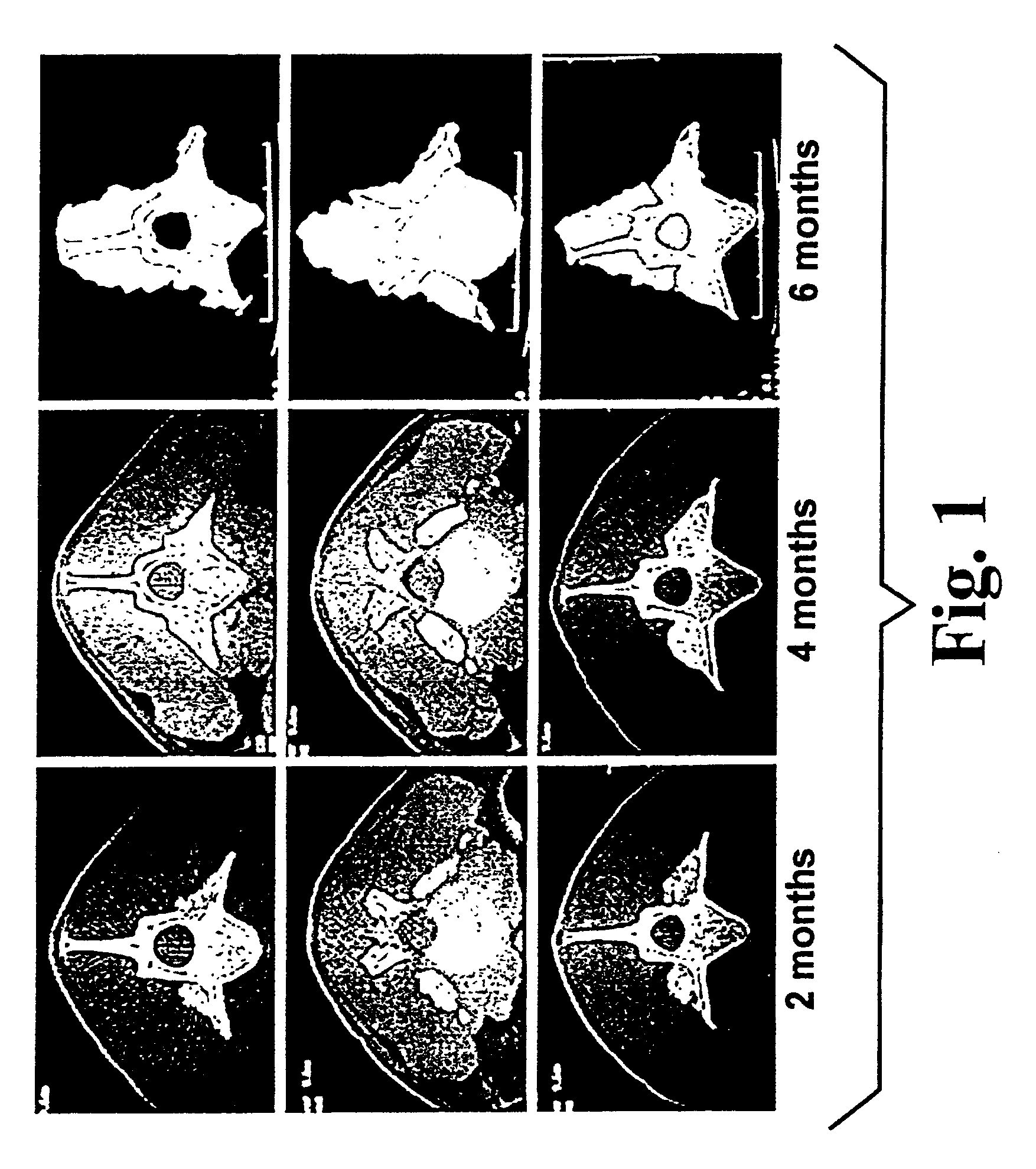 Highly-mineralized osteogenic sponge compositions and uses thereof