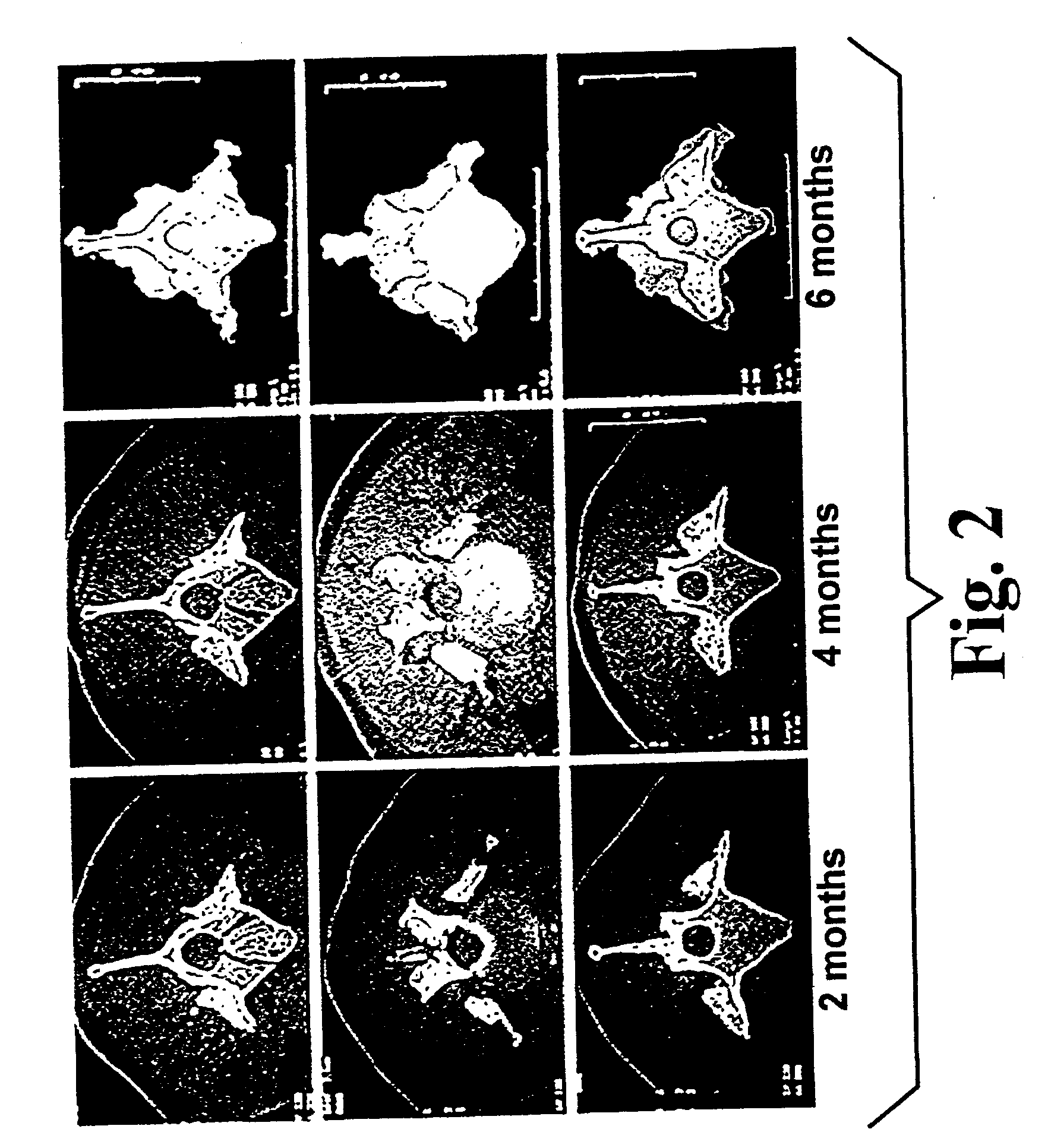 Highly-mineralized osteogenic sponge compositions and uses thereof