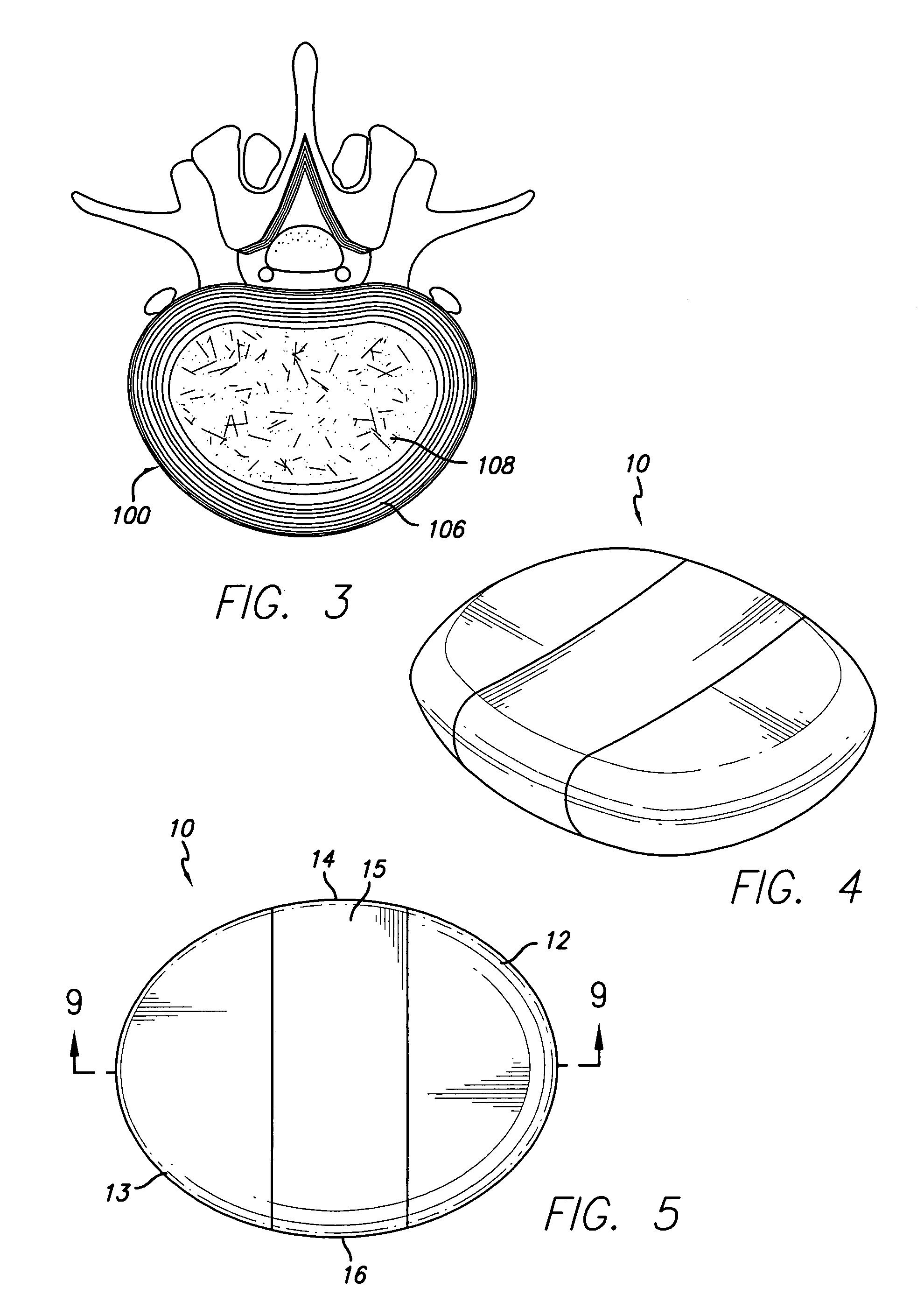 Implant material for minimally invasive spinal interbody fusion surgery