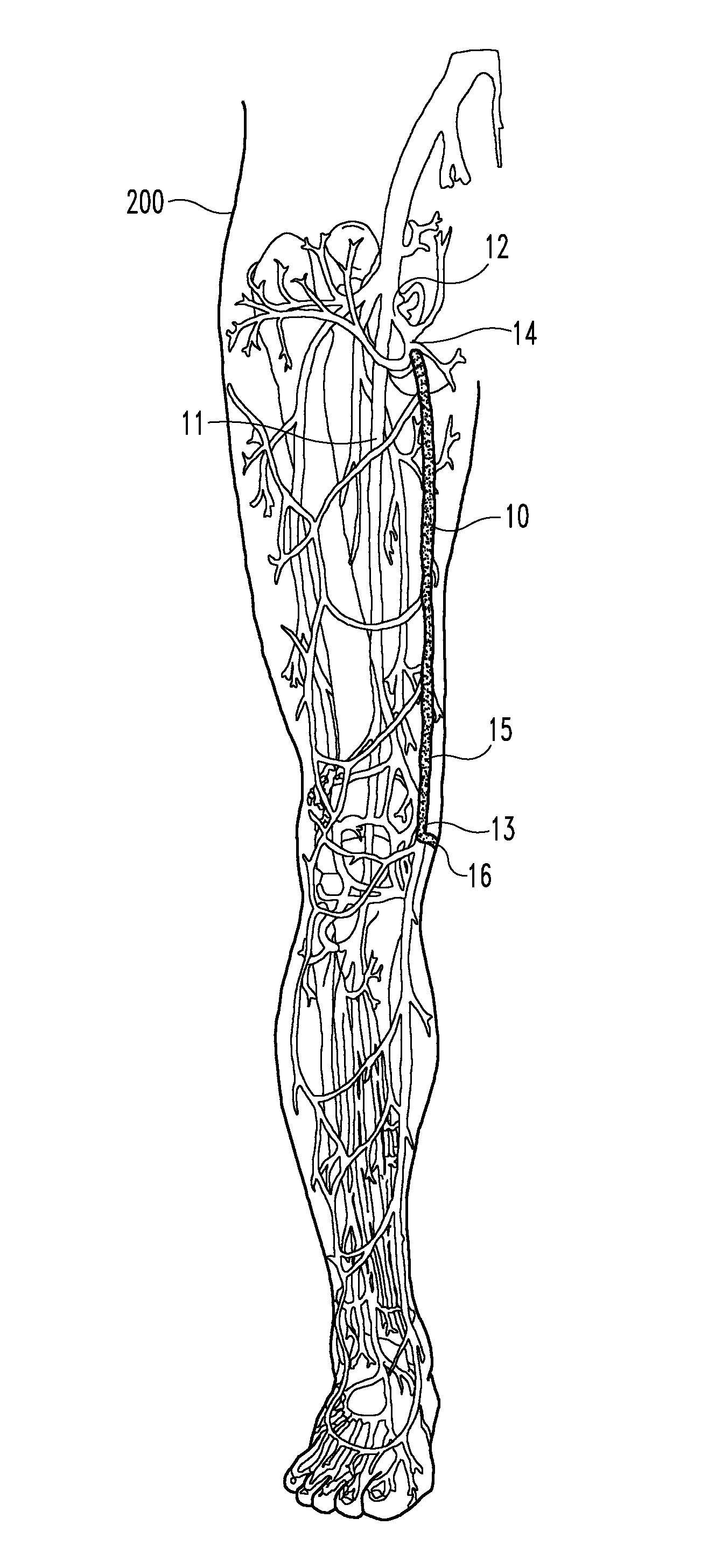 Methods for occluding bodily vessels