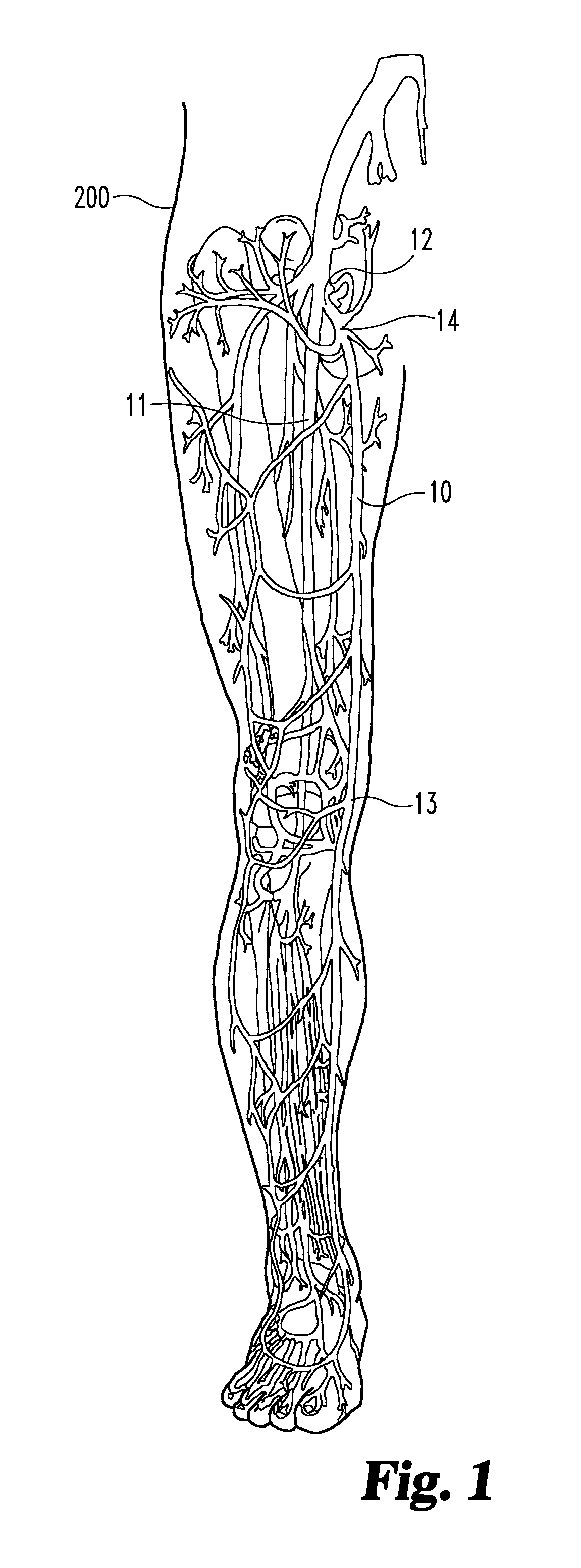Methods for occluding bodily vessels
