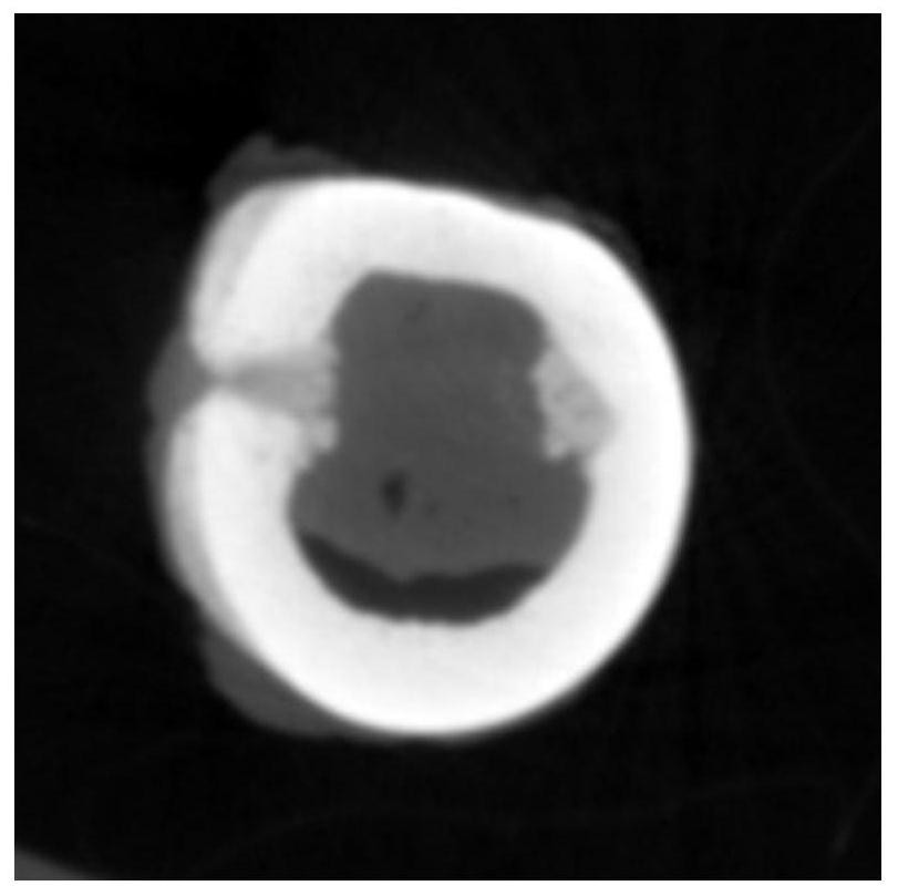 A kind of absorbable reinforced bone implant material and its preparation method