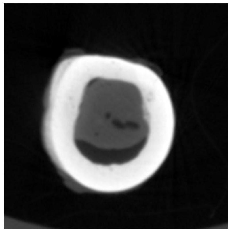 A kind of absorbable reinforced bone implant material and its preparation method