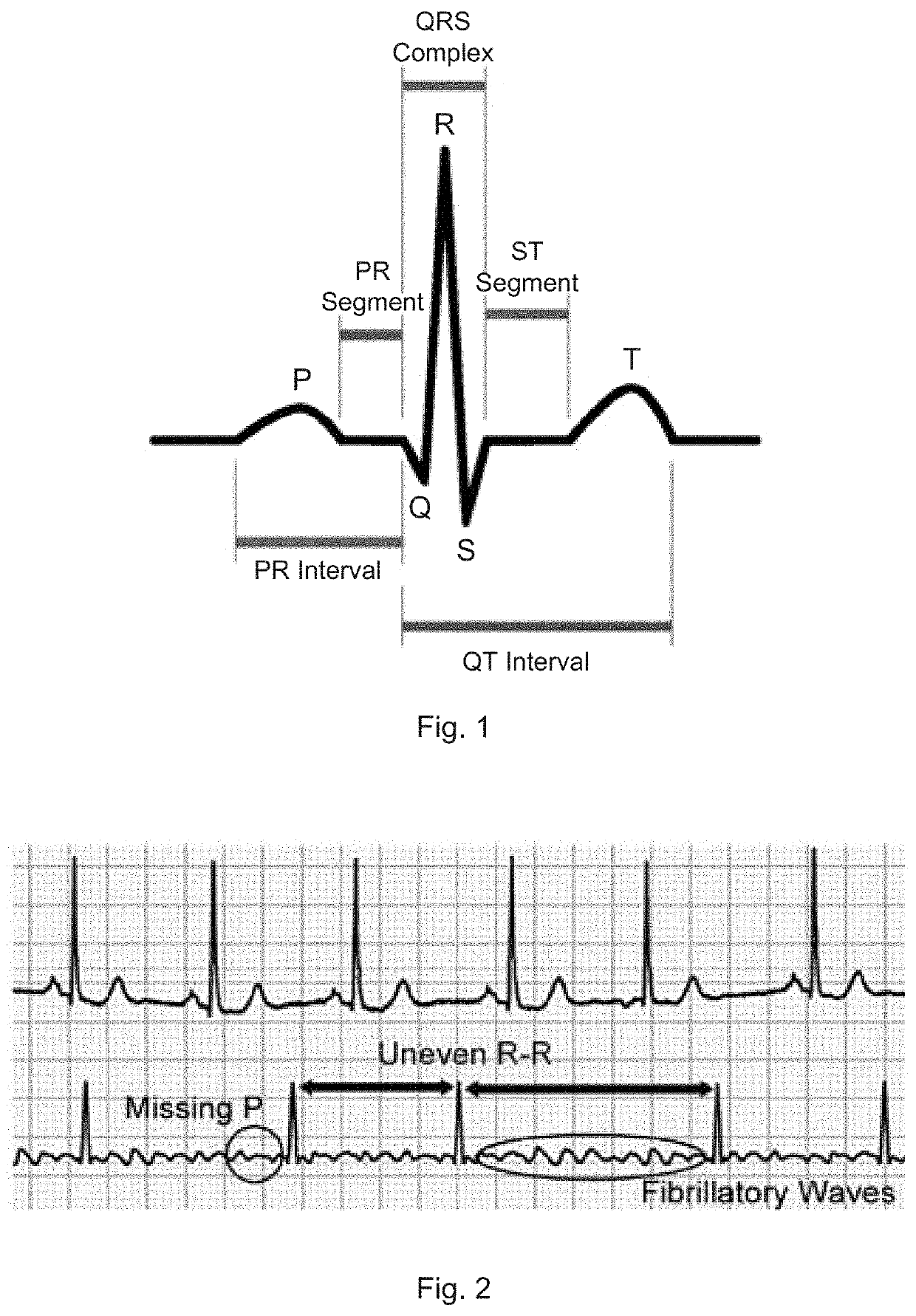 Method of detecting abnormalities in ECG signals