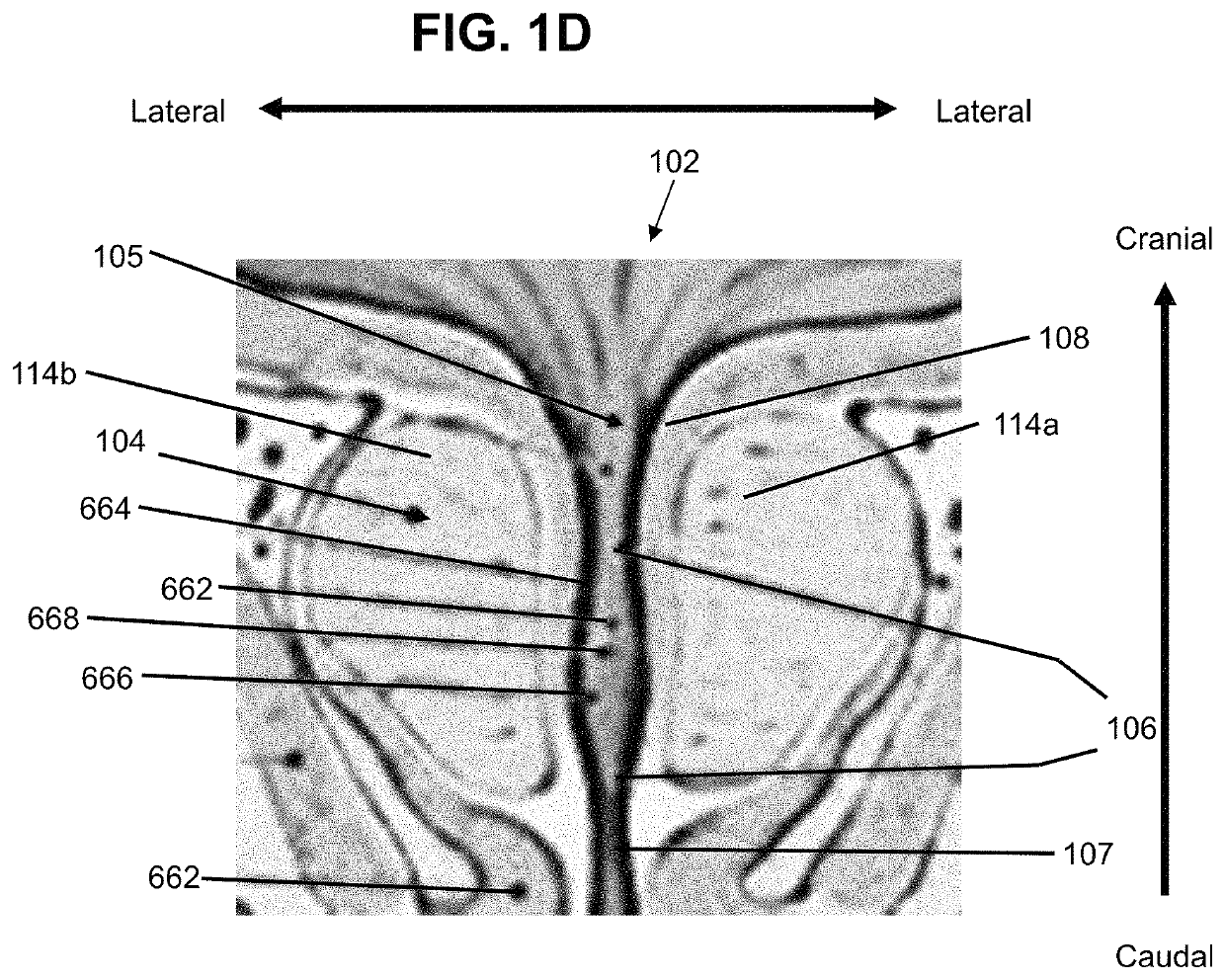 Dilating device and method for prostatic urethra