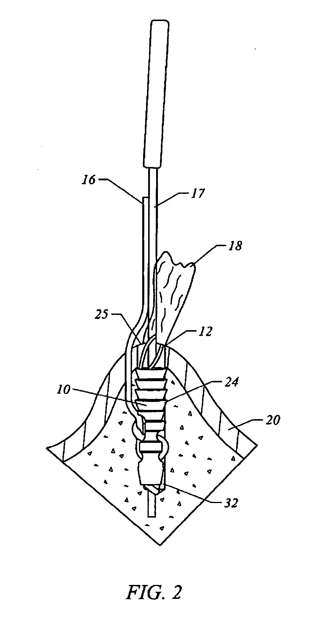 Bone anchor suture-loading system, method and apparatus