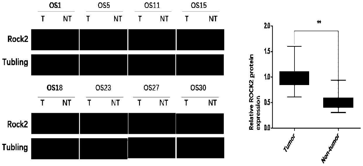 Application of ROCK2 to preparation of TRAIL reverse tolerance medicines for treating reverse osteosarcoma cells