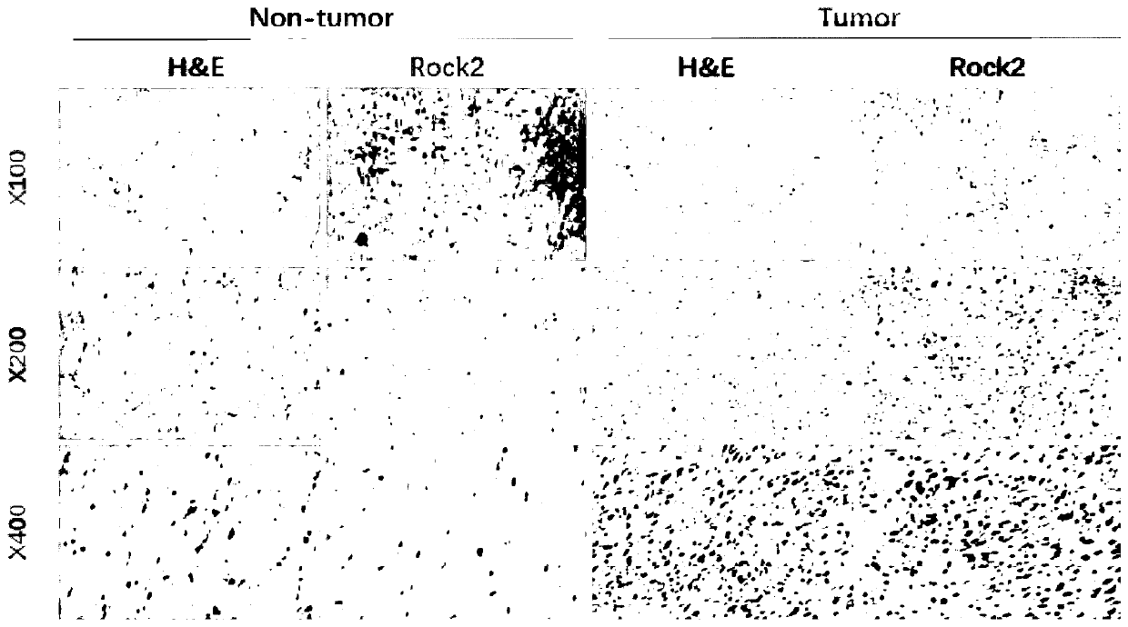 Application of ROCK2 to preparation of TRAIL reverse tolerance medicines for treating reverse osteosarcoma cells