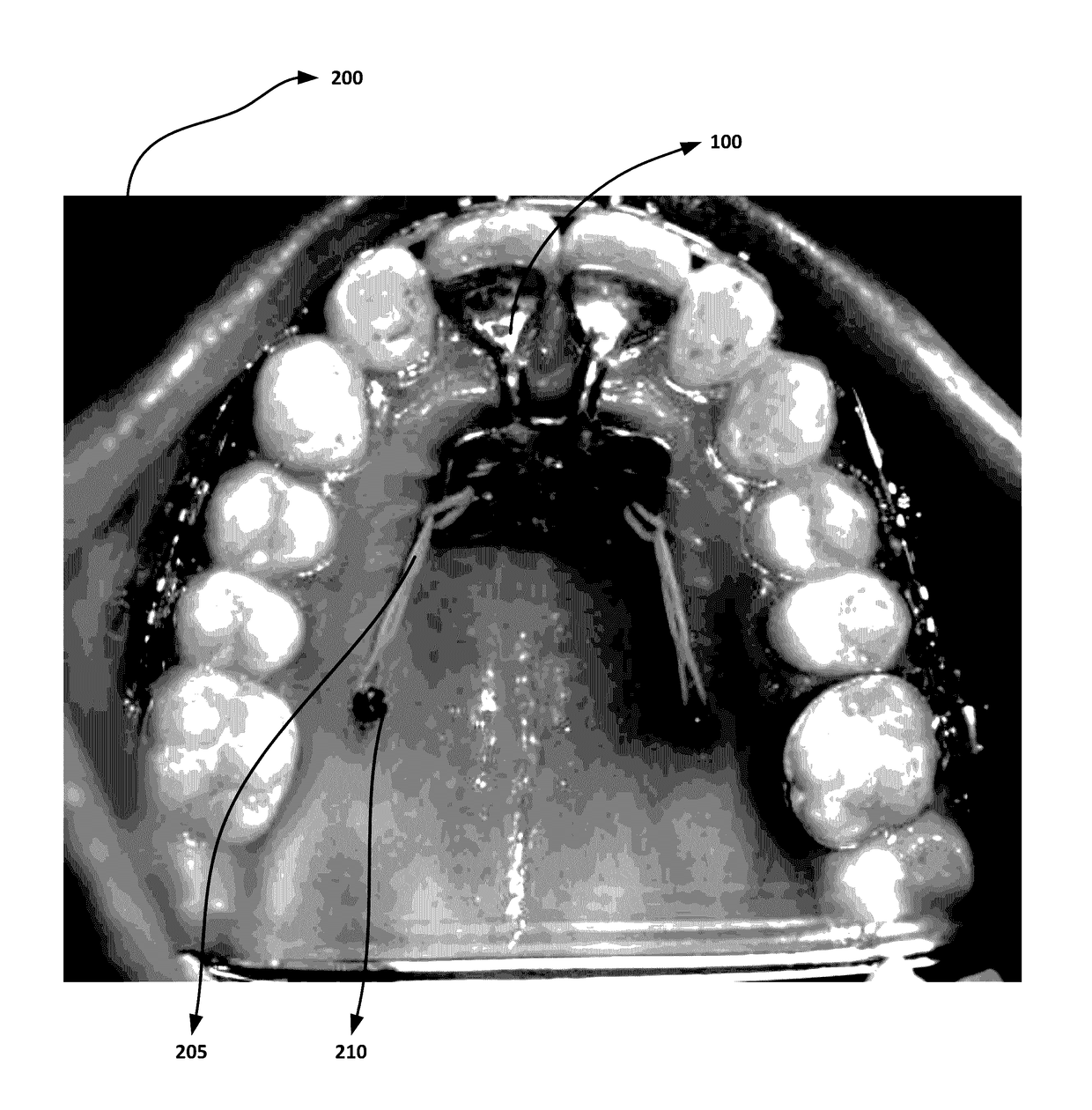 Orthodontic appliance for distalization and/or space closure