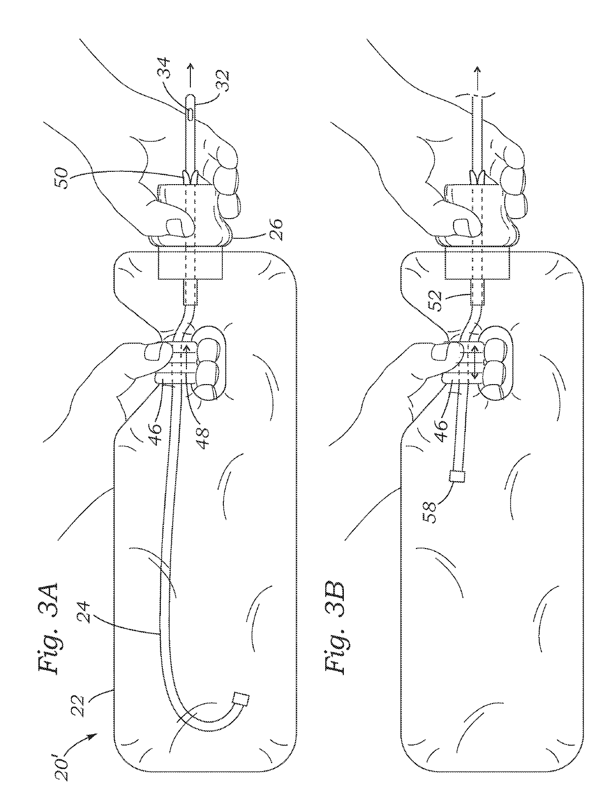Closed system with intermittent urinary catheter feed