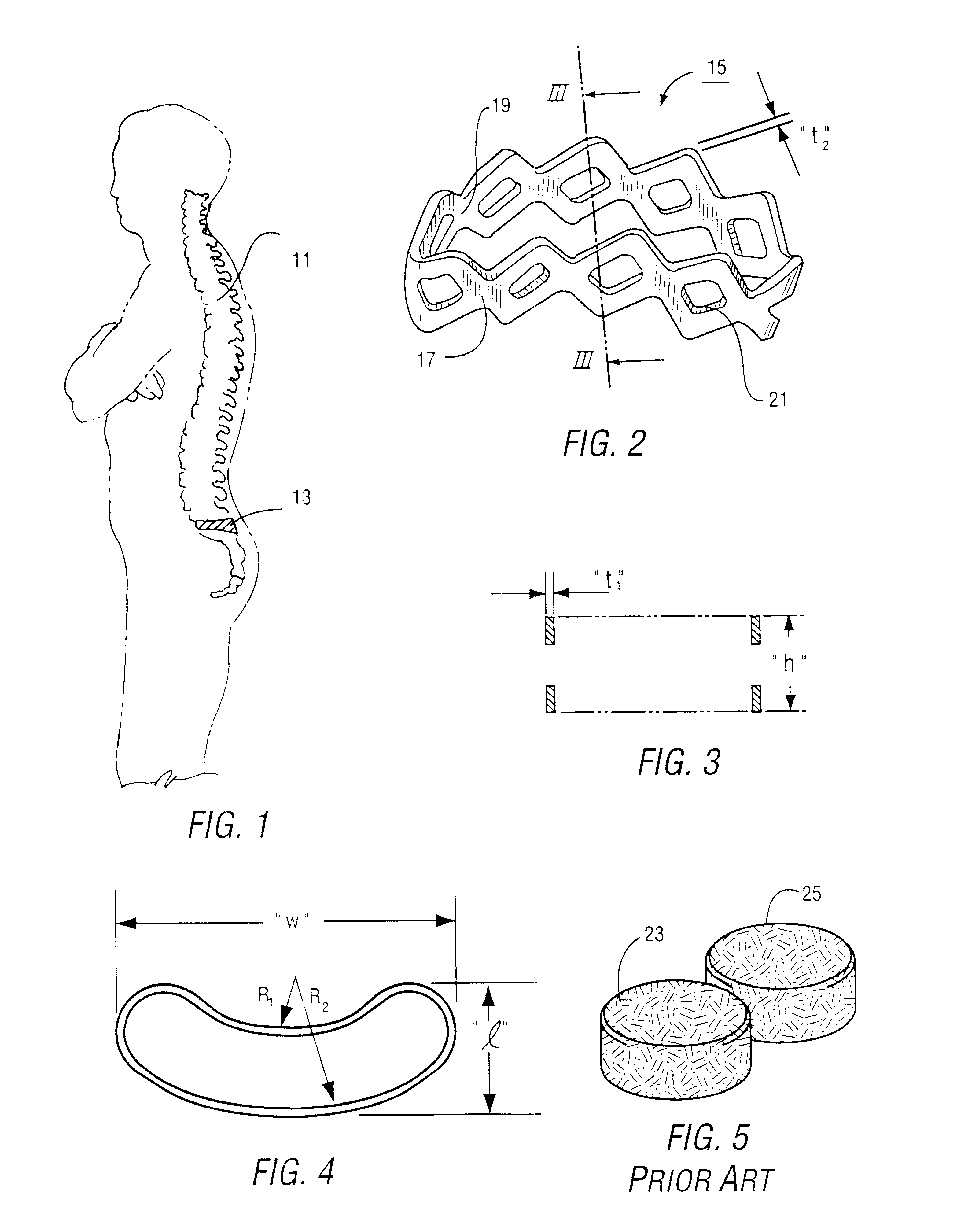 Intervertebral cage and method of use