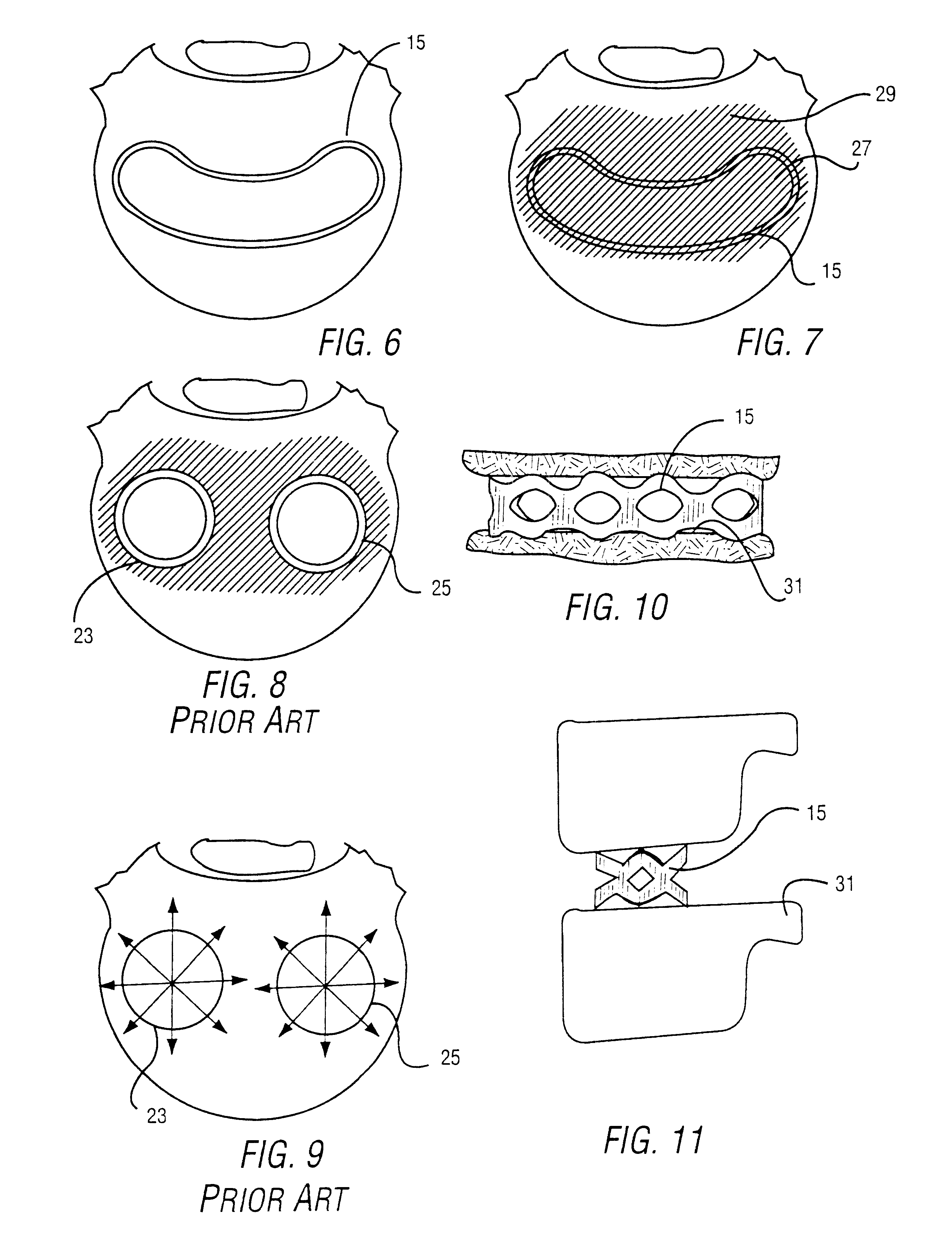 Intervertebral cage and method of use