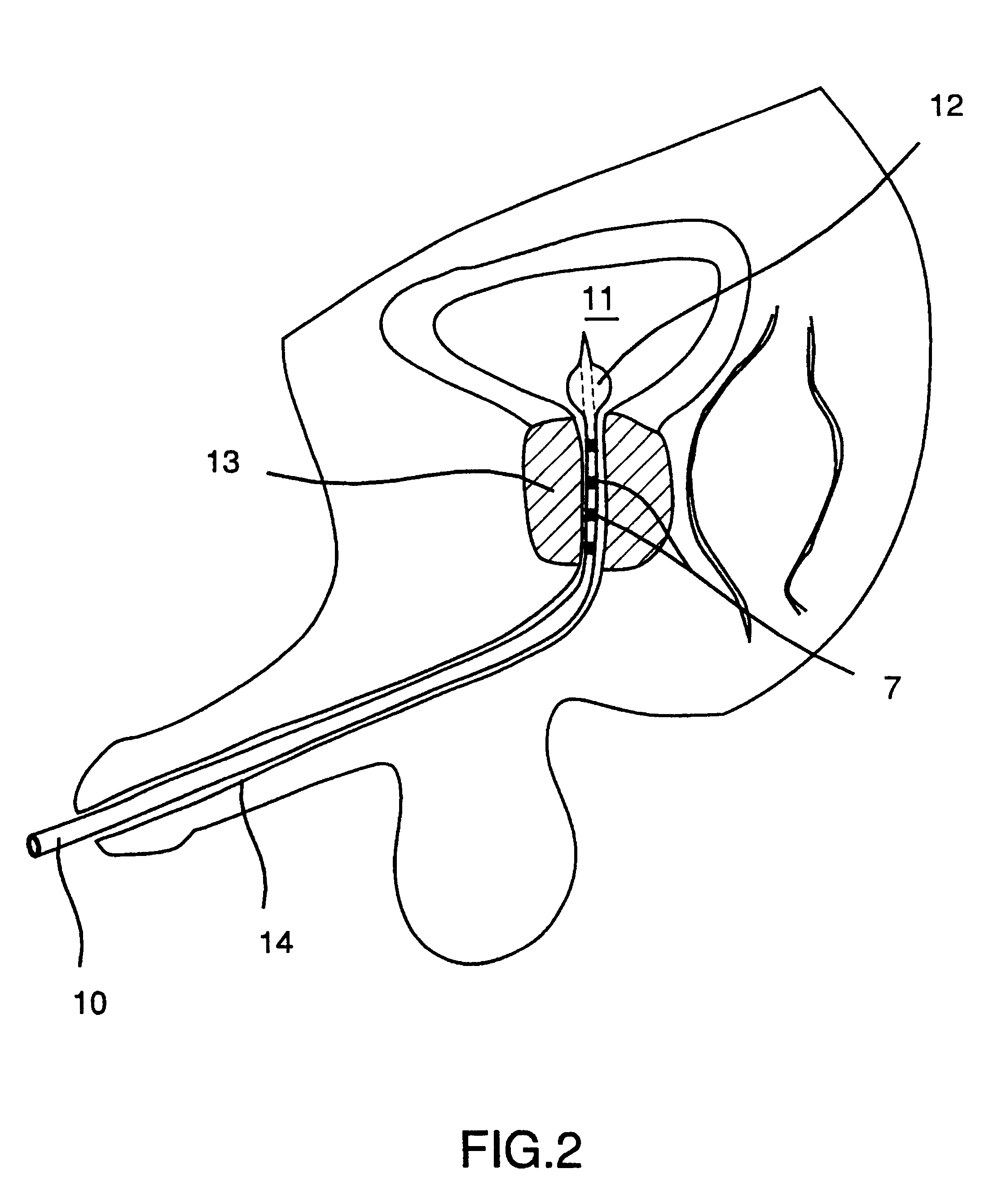 Arrangement and reference means to direct a beam in radiation therapy