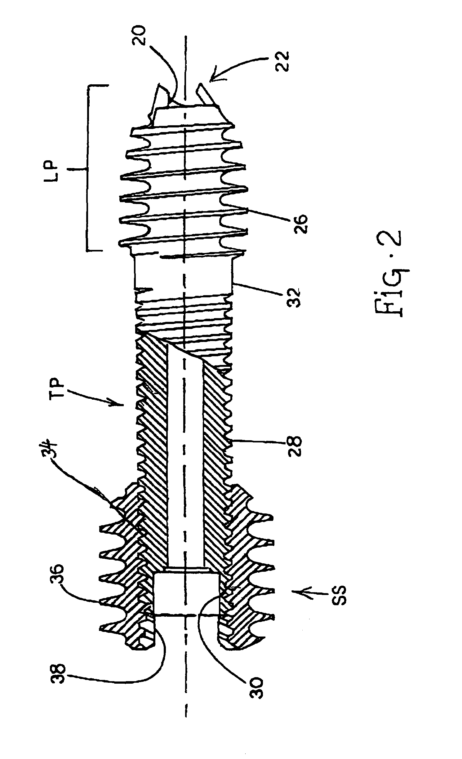 Compression screw apparatuses, systems and methods