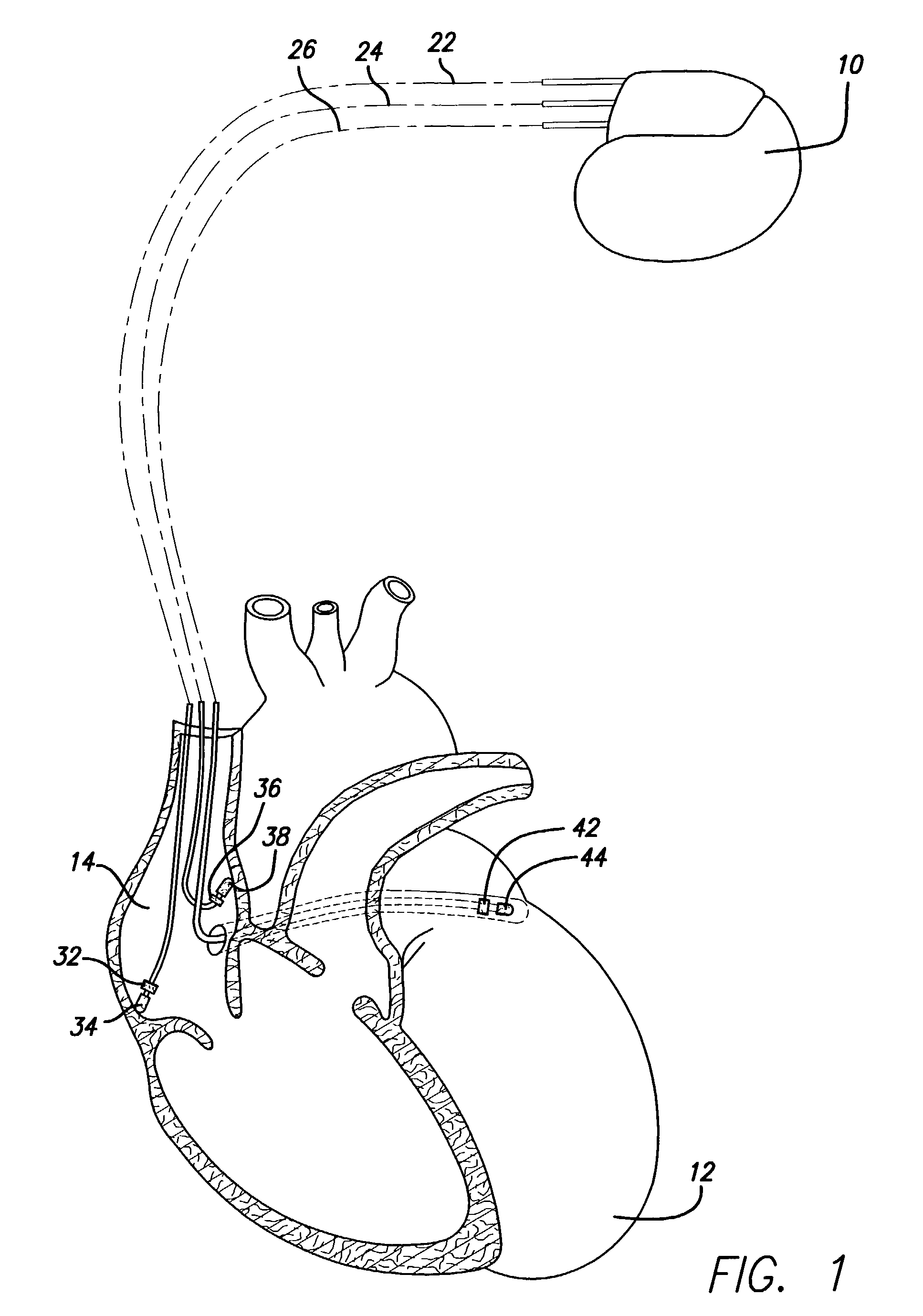 Methods and apparatus for overdrive pacing multiple atrial sites using an implantable cardiac stimulation device