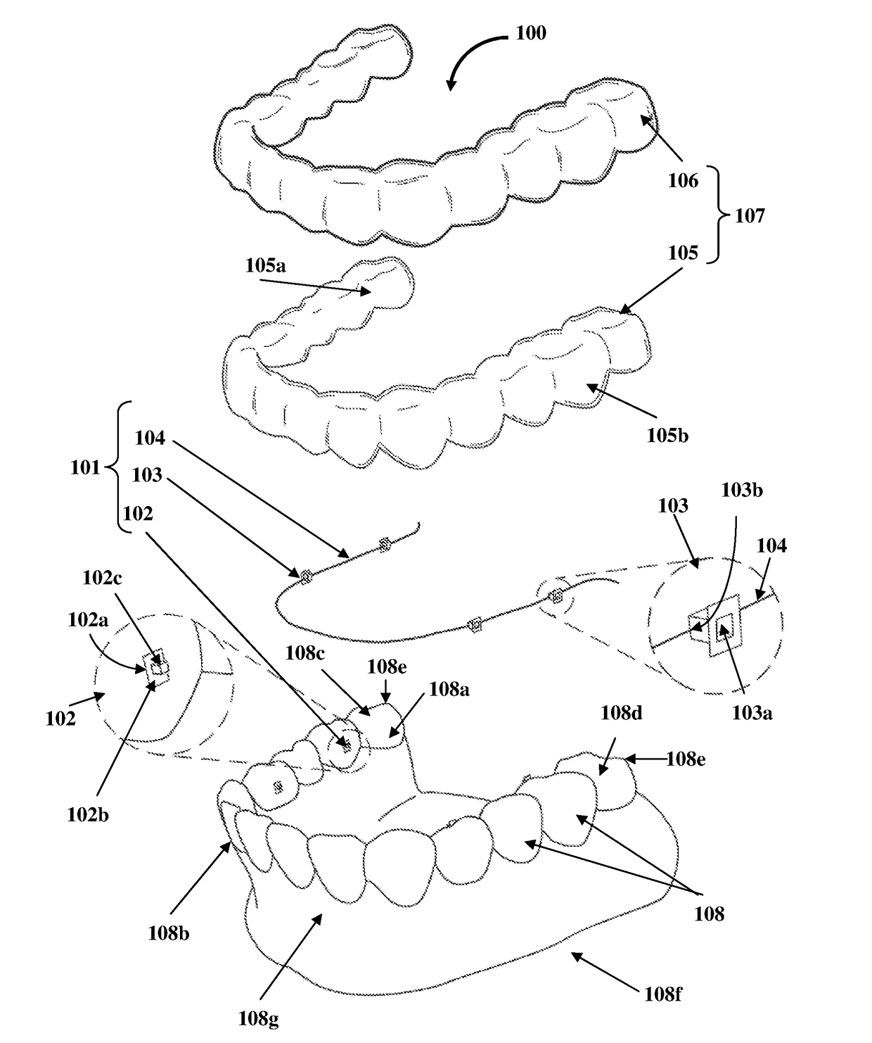Detachable Orthodontic Bracket And Wire System