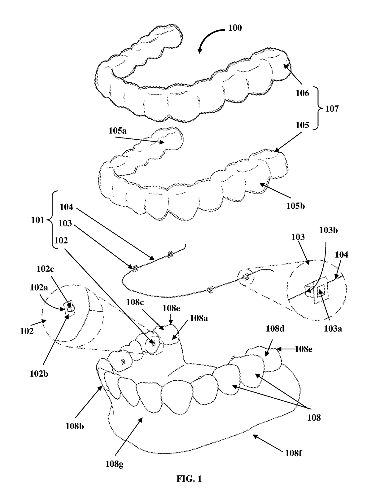 Detachable Orthodontic Bracket And Wire System