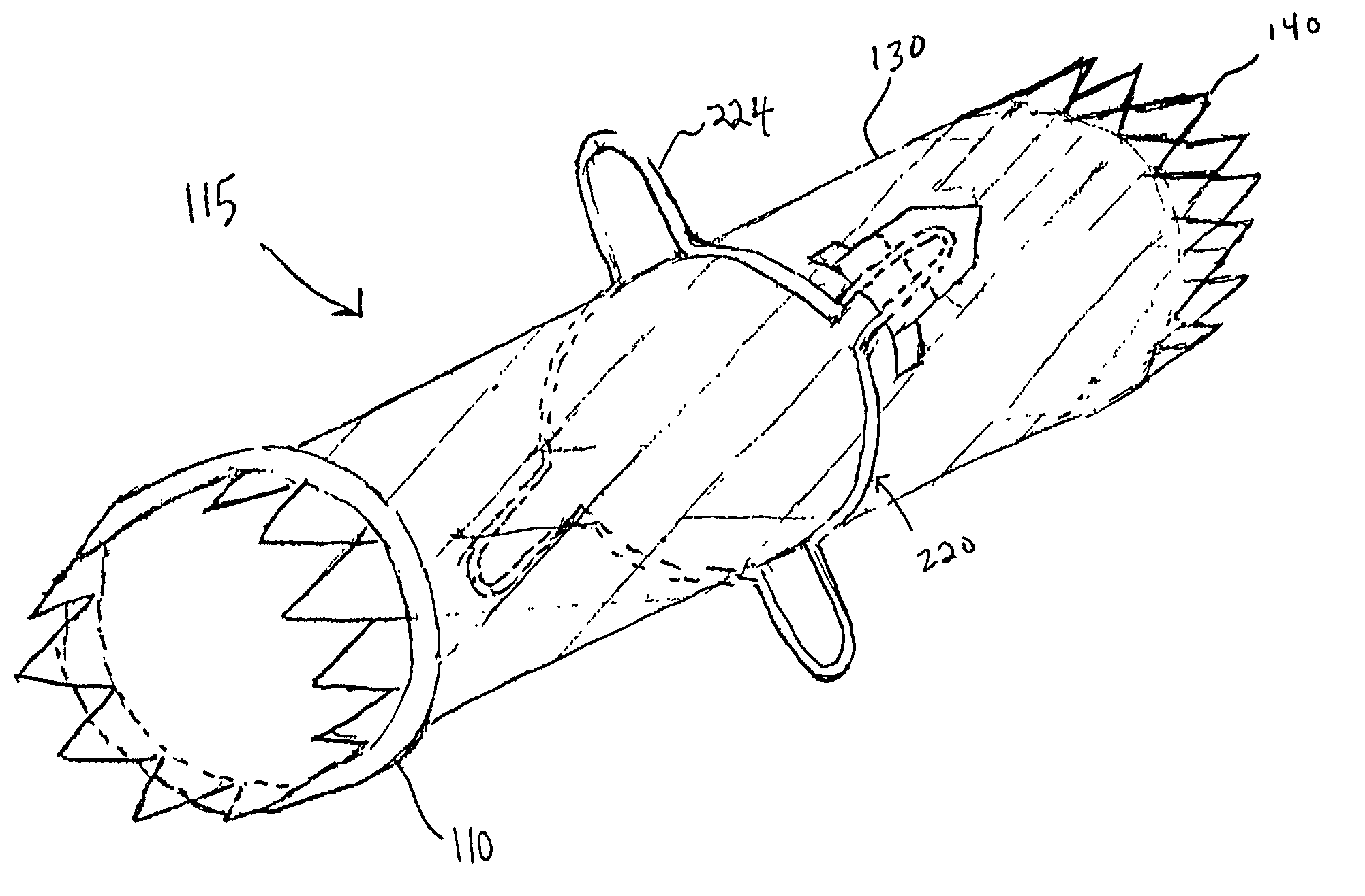 Implant having improved fixation to a body lumen and method for implanting the same