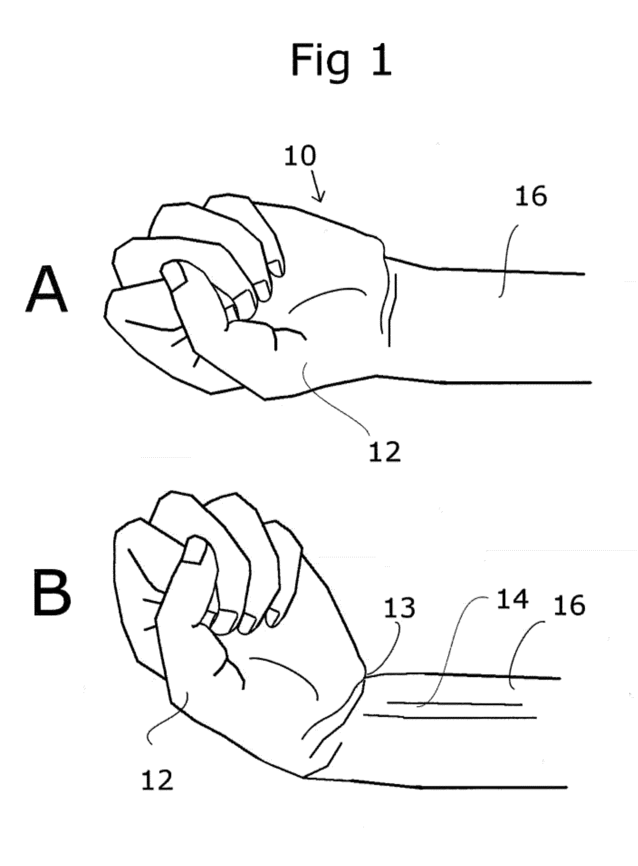 Method and device to alleviate carpal tunnel syndrome and dysfunctions of other soft tissues