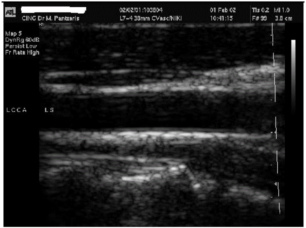 Carotid ultrasound image intima media thickness measurement method and system thereof