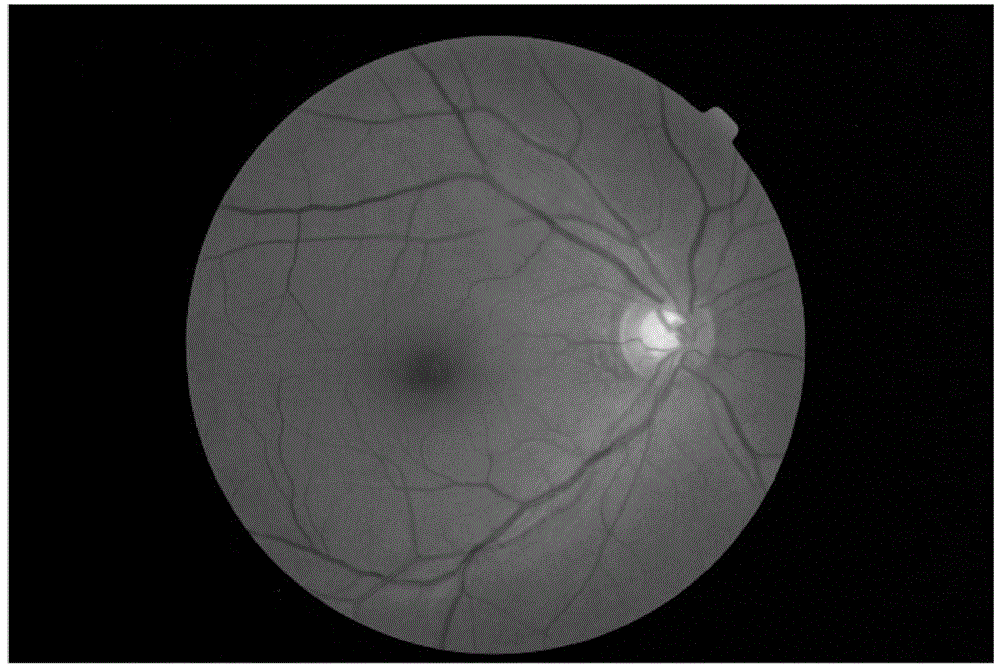 Eye fundus image optical cup automatic segmentation method based on improved PDE image repairing