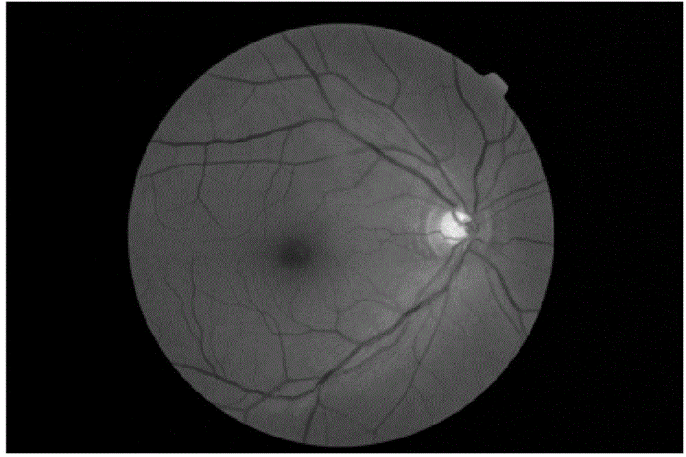 Eye fundus image optical cup automatic segmentation method based on improved PDE image repairing