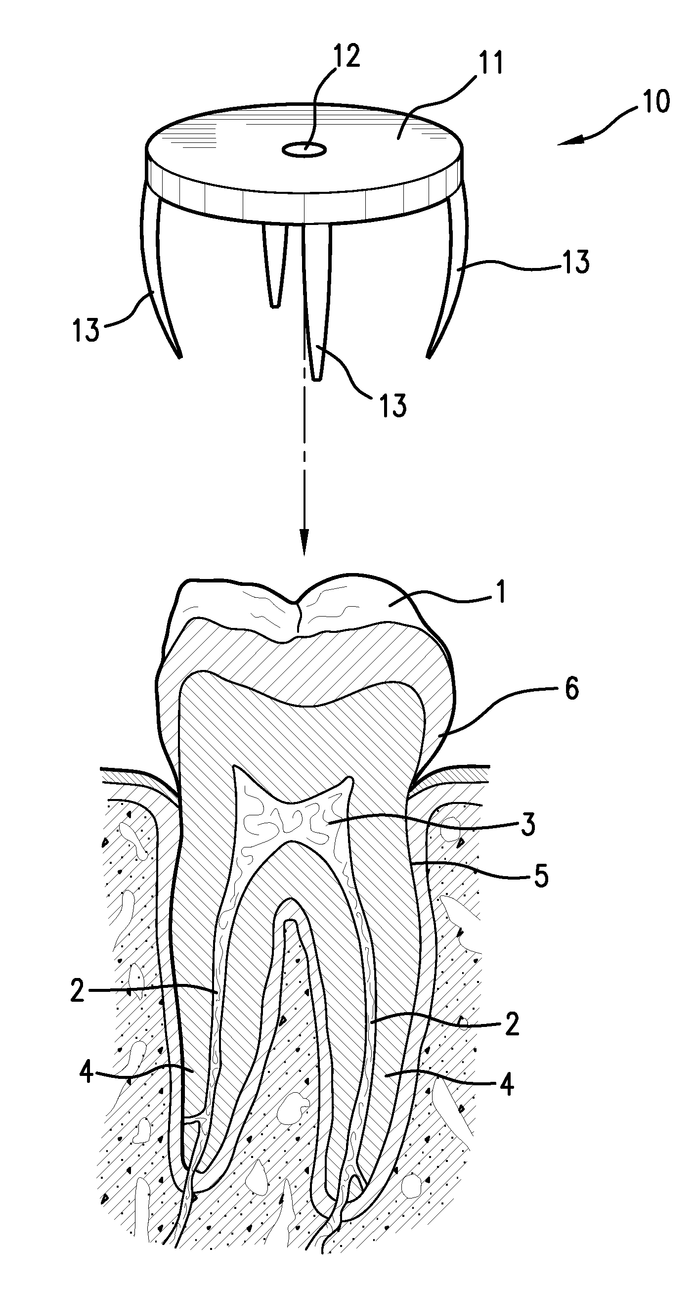 Device and method for locating a pulp chamber in a tooth