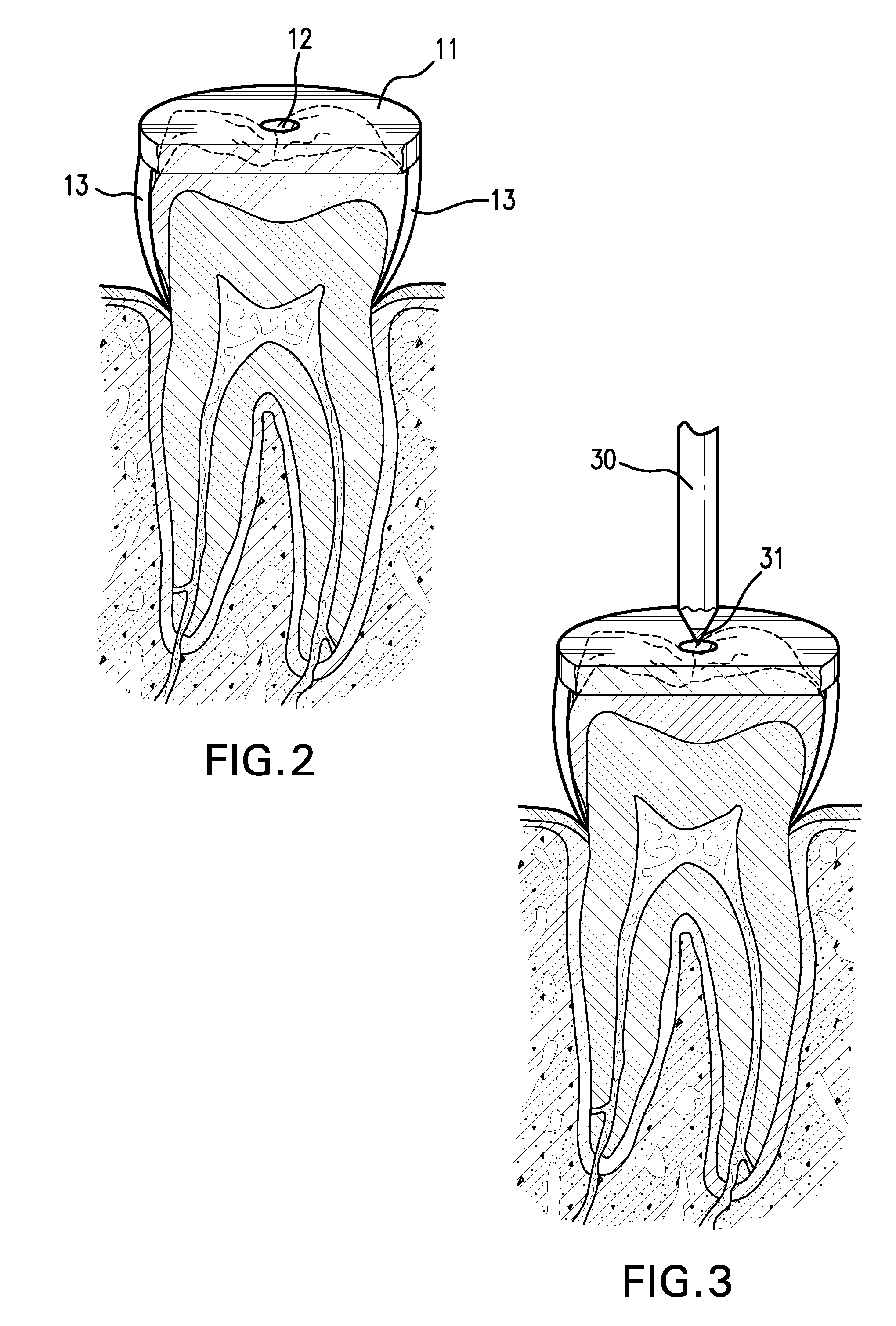 Device and method for locating a pulp chamber in a tooth