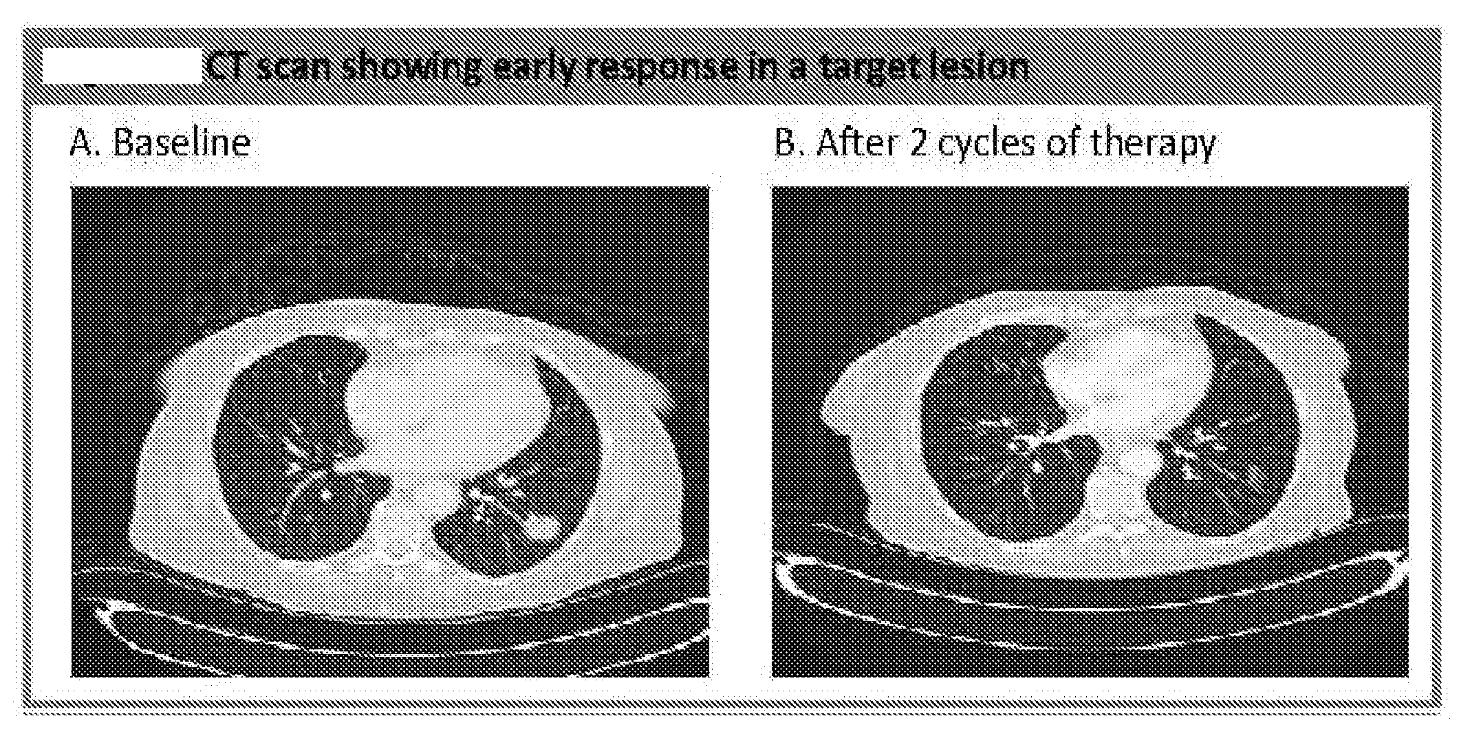 Methods of treatment of pancreatic cancer