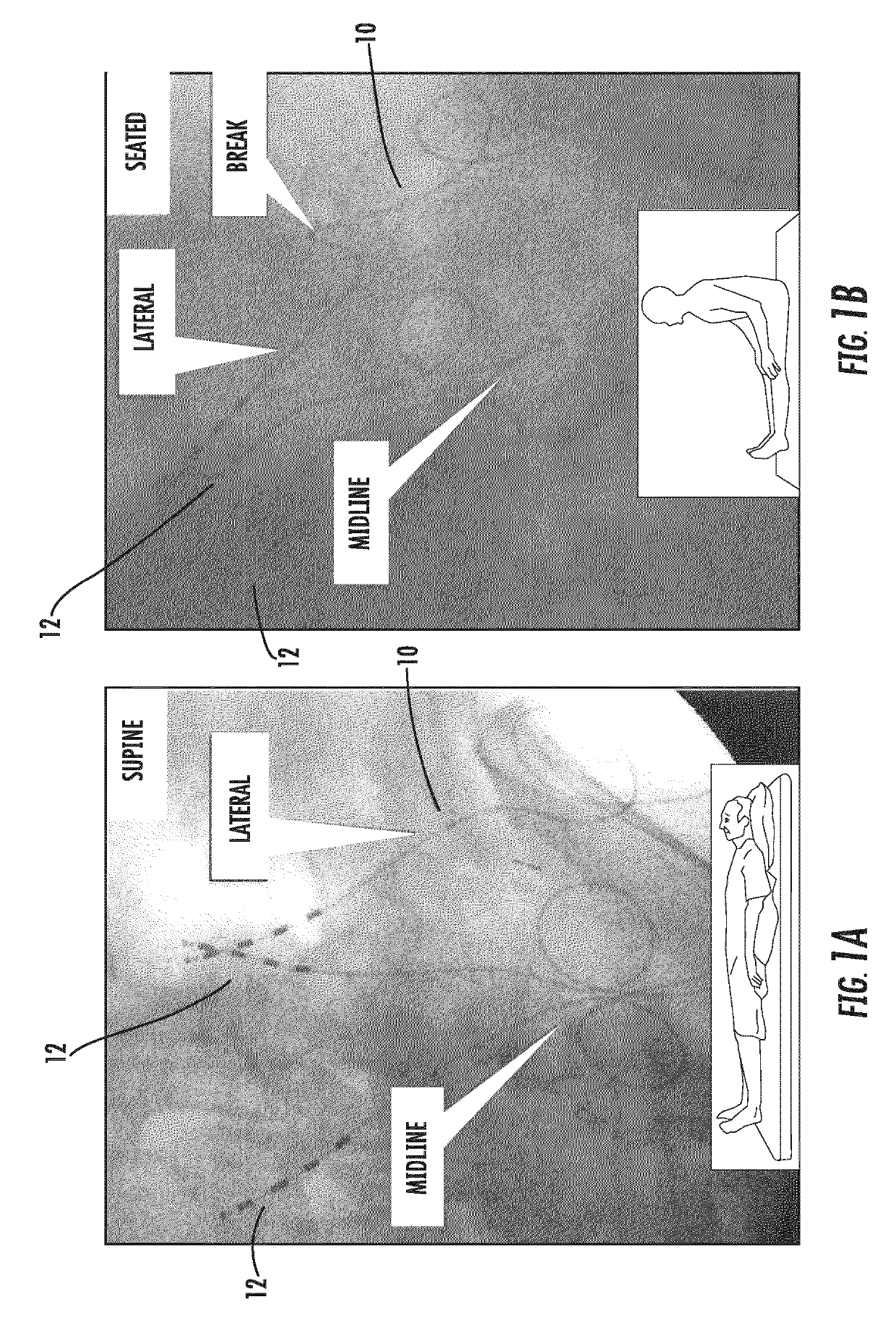 Systems and methods for enhanced implantation of electrode leads between tissue layers