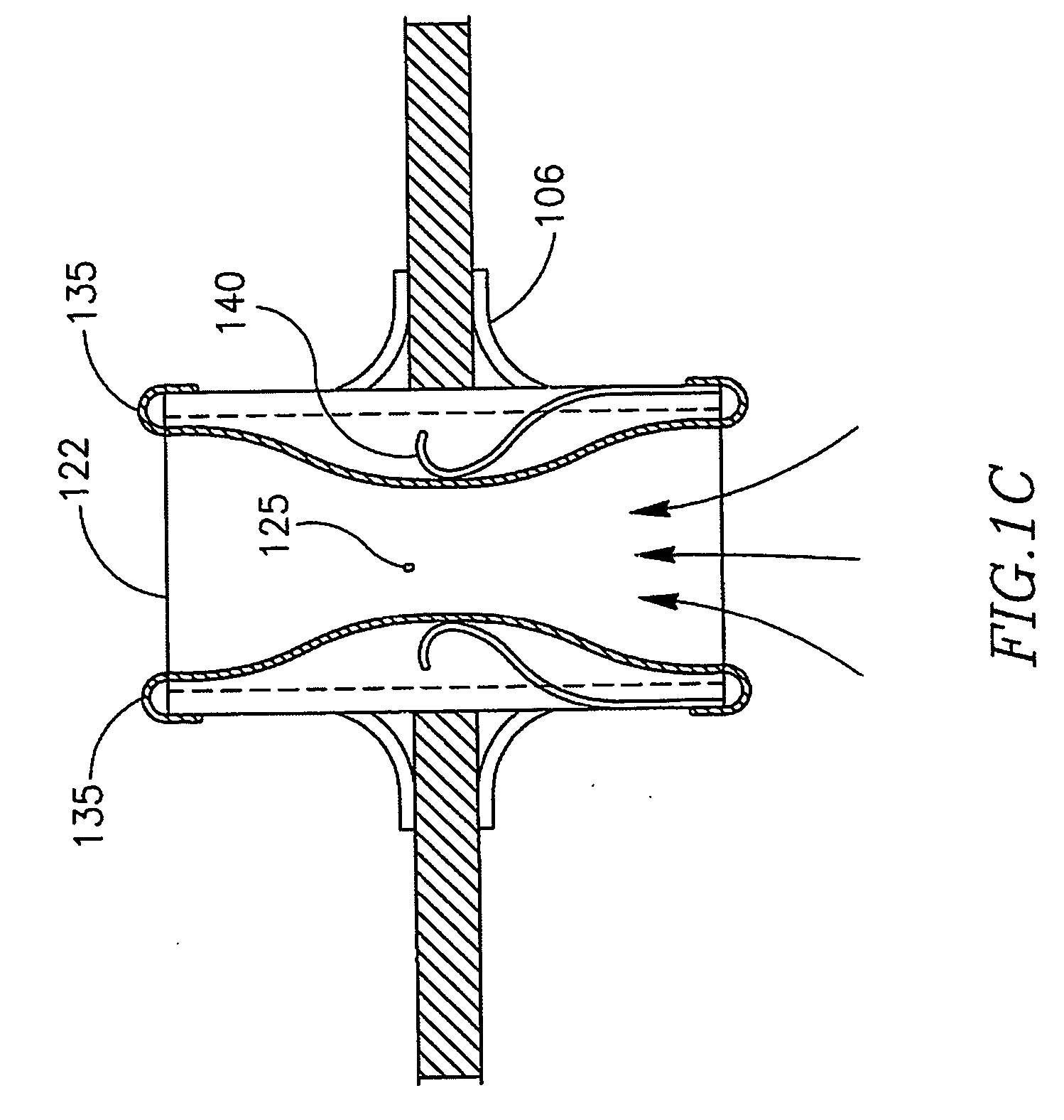 Device and method for controlling in-vivo pressure