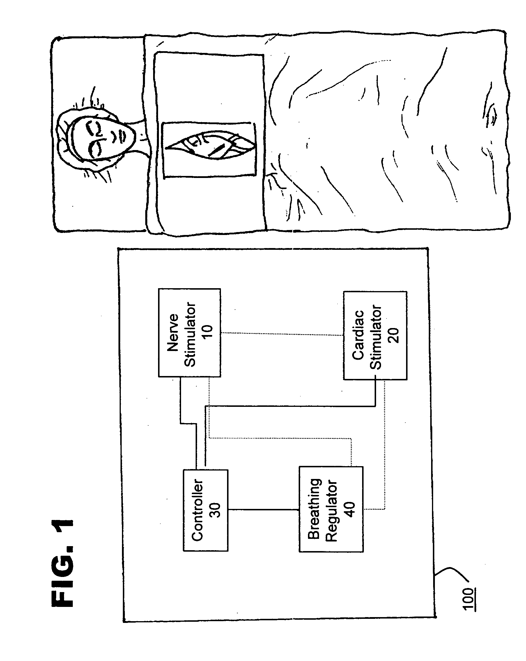 Method and system for nerve stimulation prior to and during a medical procedure