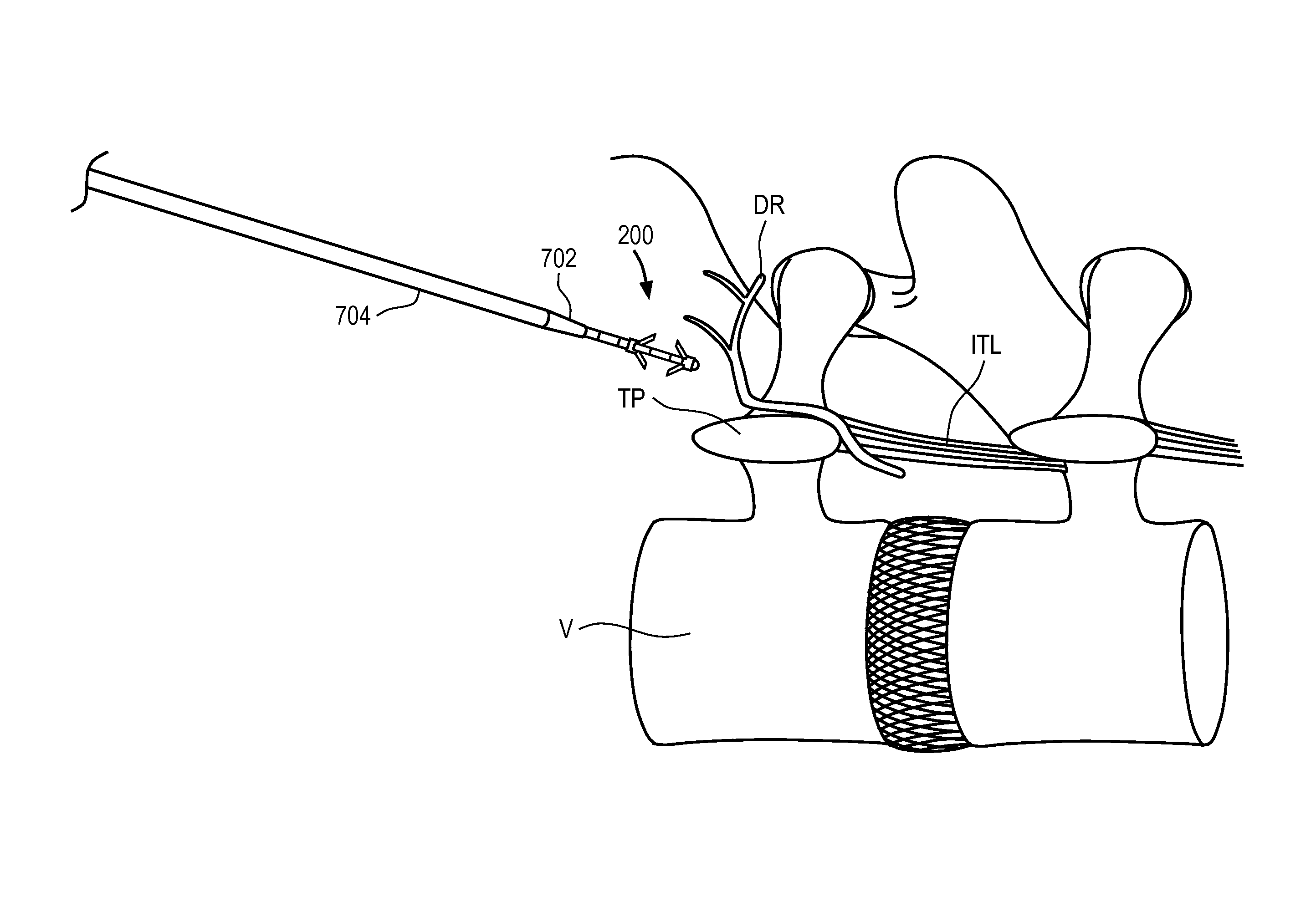 Systems and methods for restoring muscle function to the lumbar spine