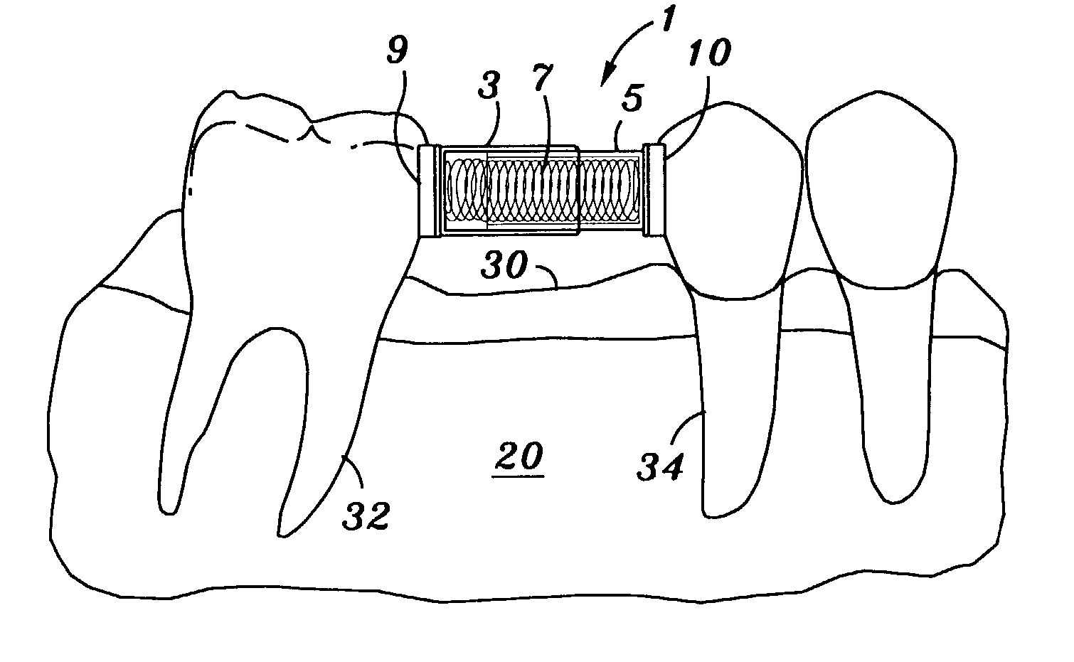 Adjustable tooth spreading and uprighting device