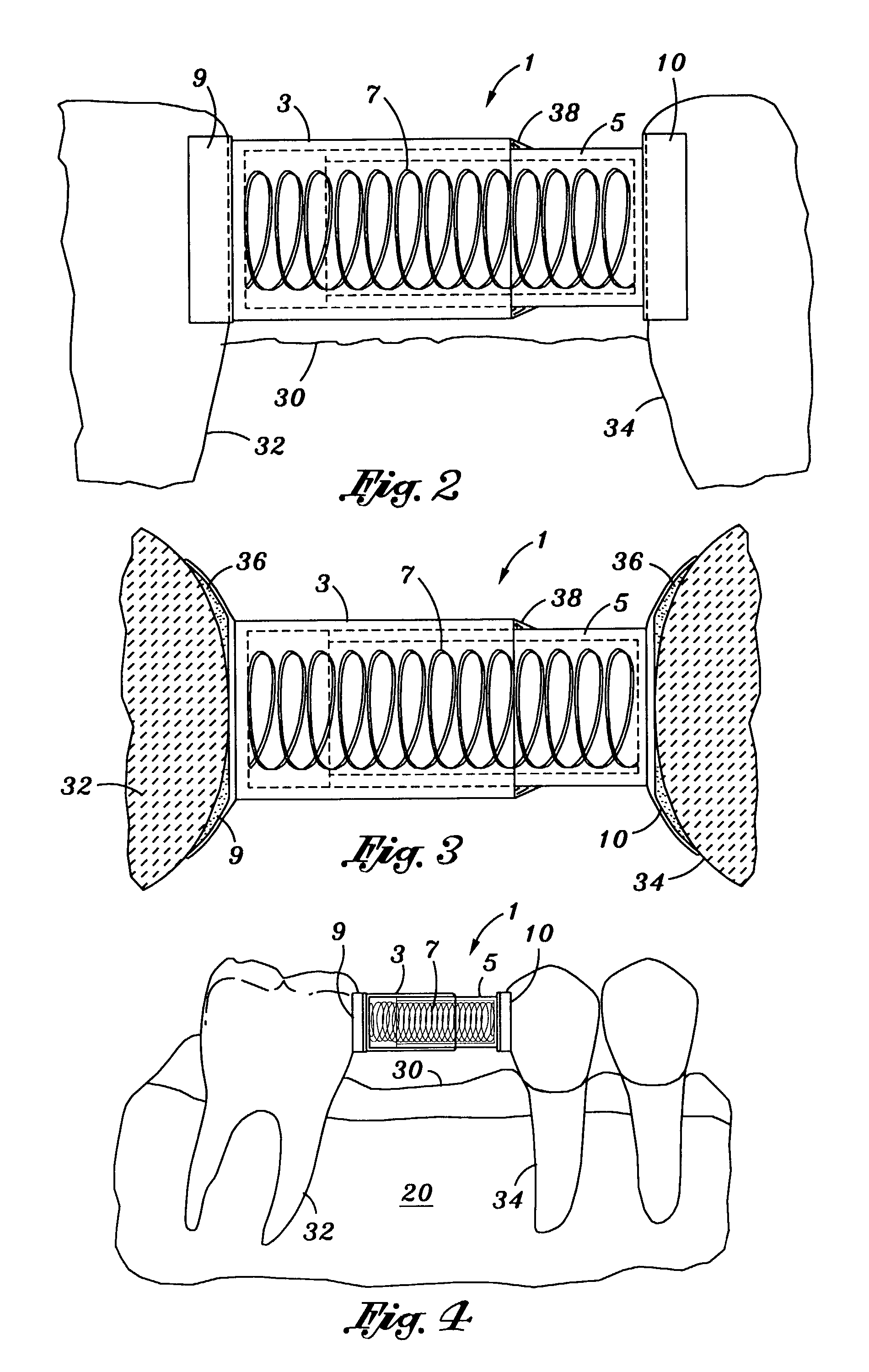Adjustable tooth spreading and uprighting device