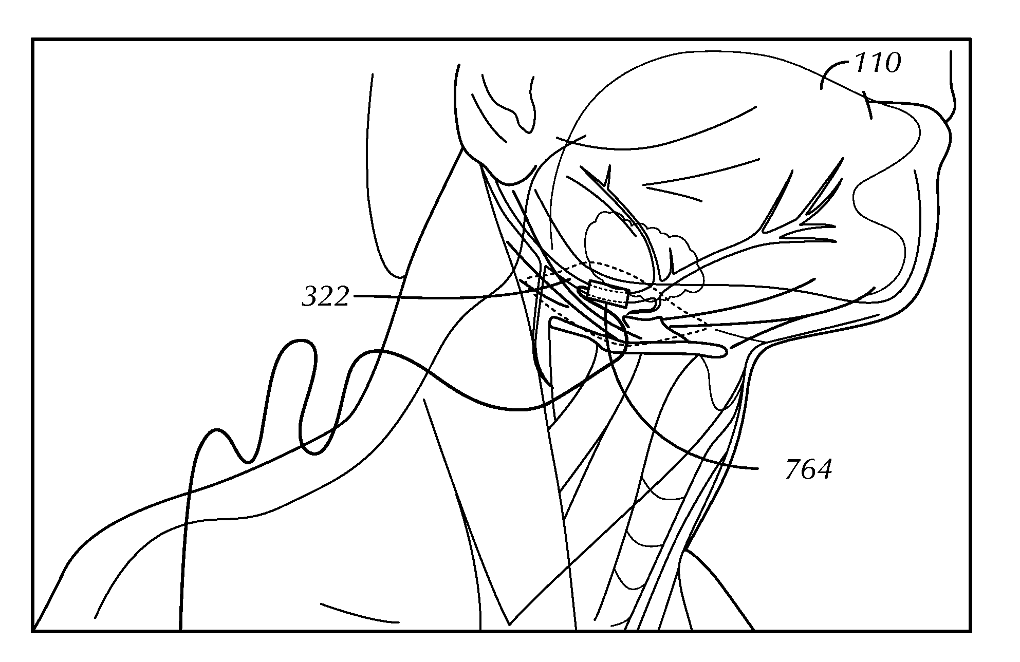 System for stimulating a hypoglossal nerve for controlling the position of a patient's tongue
