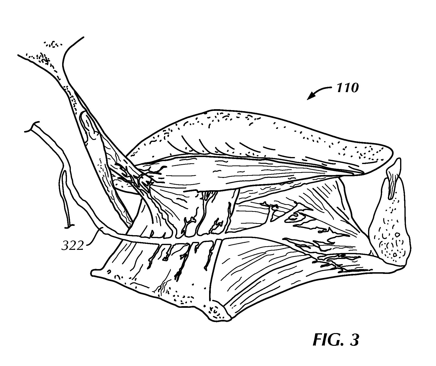 System for stimulating a hypoglossal nerve for controlling the position of a patient's tongue