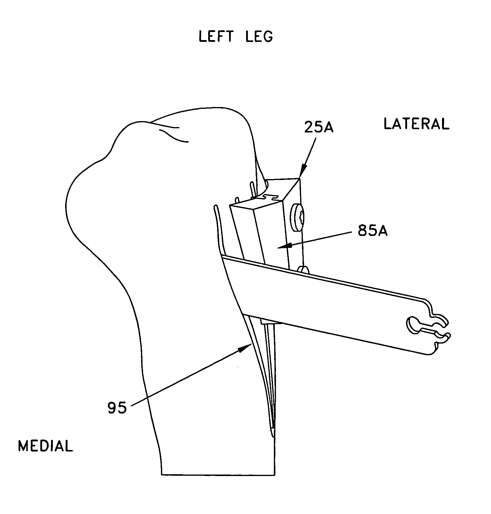 Method and apparatus for performing multidirectional tibial tubercle transfers