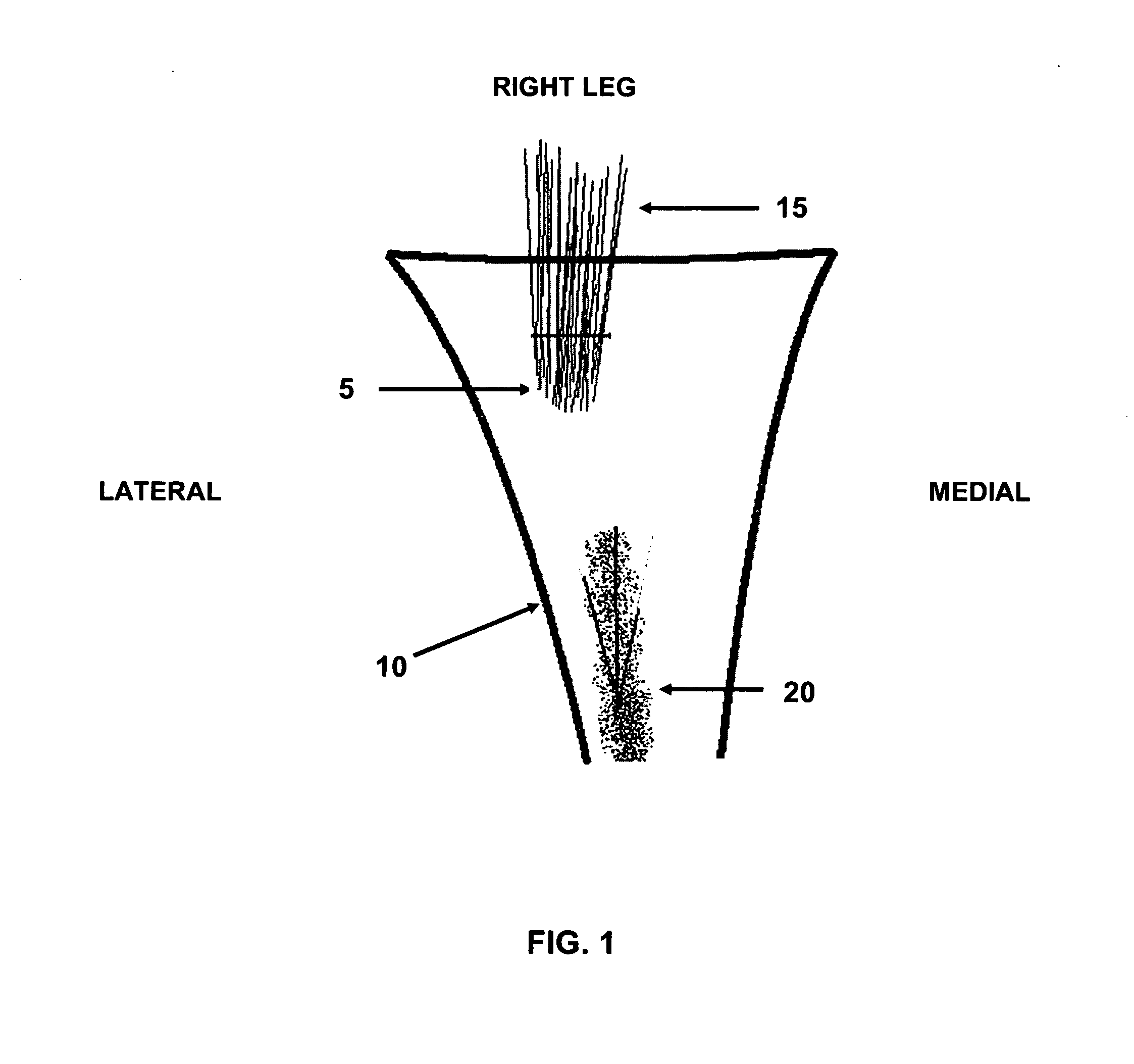 Method and apparatus for performing multidirectional tibial tubercle transfers