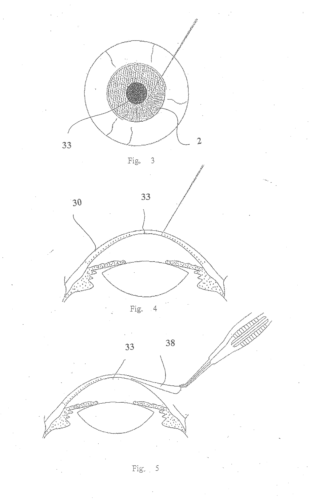 Cosmetic corneal inlay and implantation method thereof