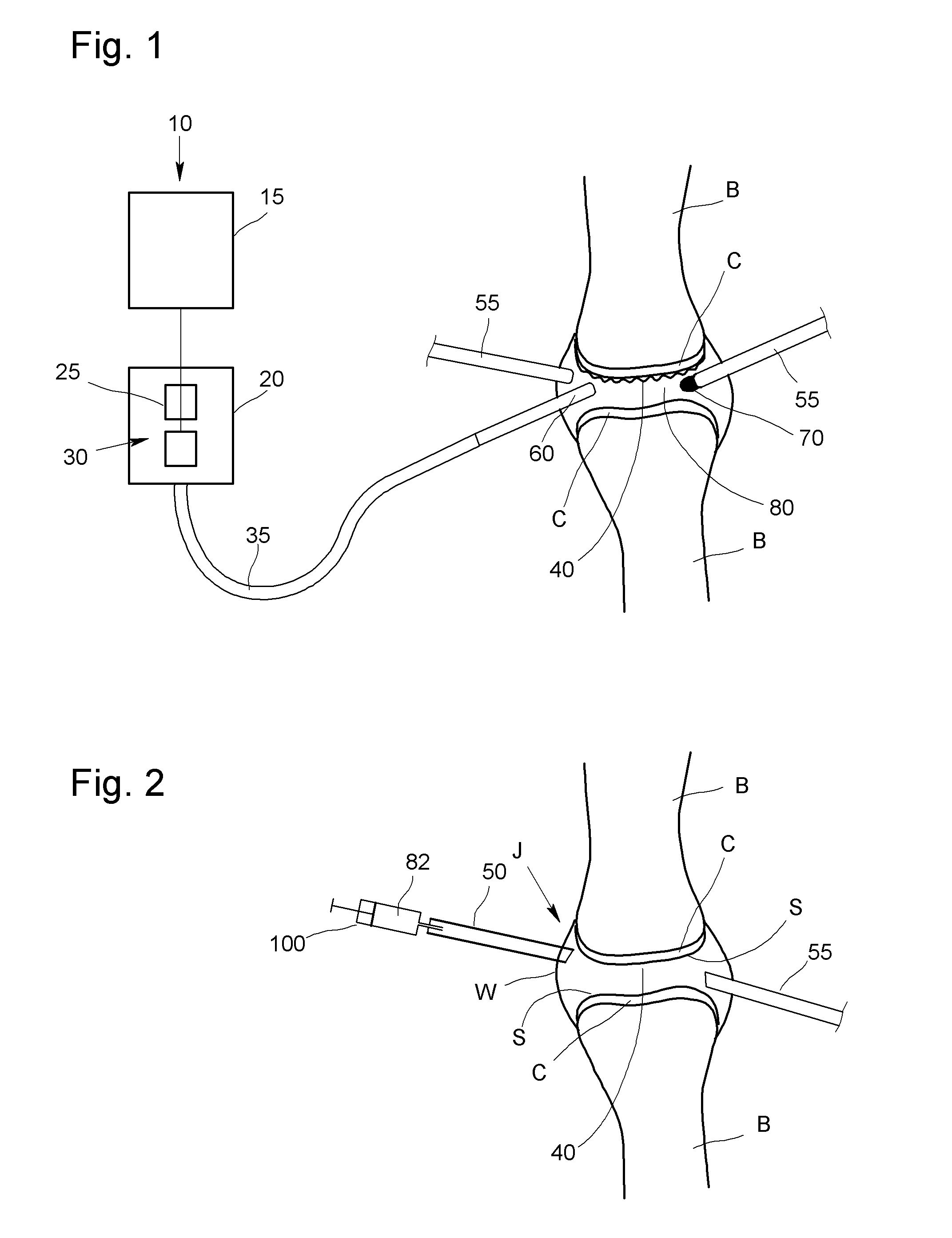 Method for the ablation of cartilage tissue in a knee joint using indocyanine