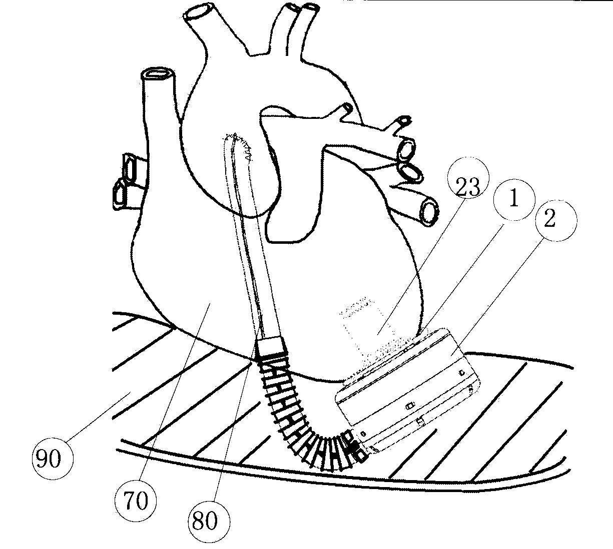 Left ventricle auxiliary blood pump