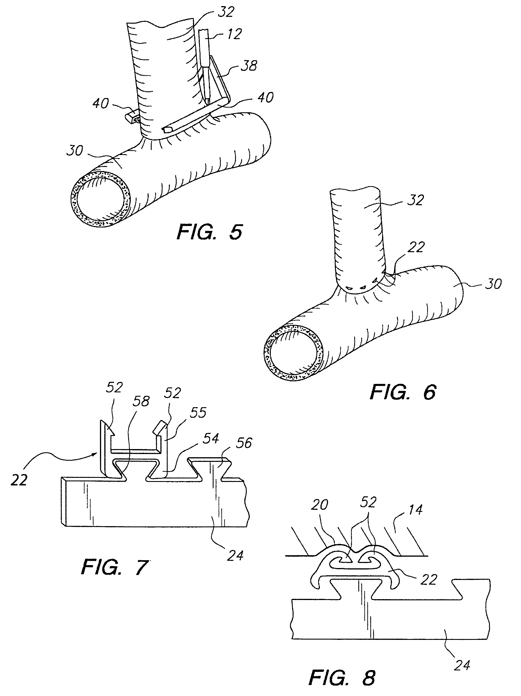 Surgical apparatus and method for anastomosis