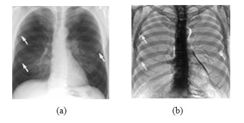 Motion correction system for dual-energy subtraction chest X-ray image